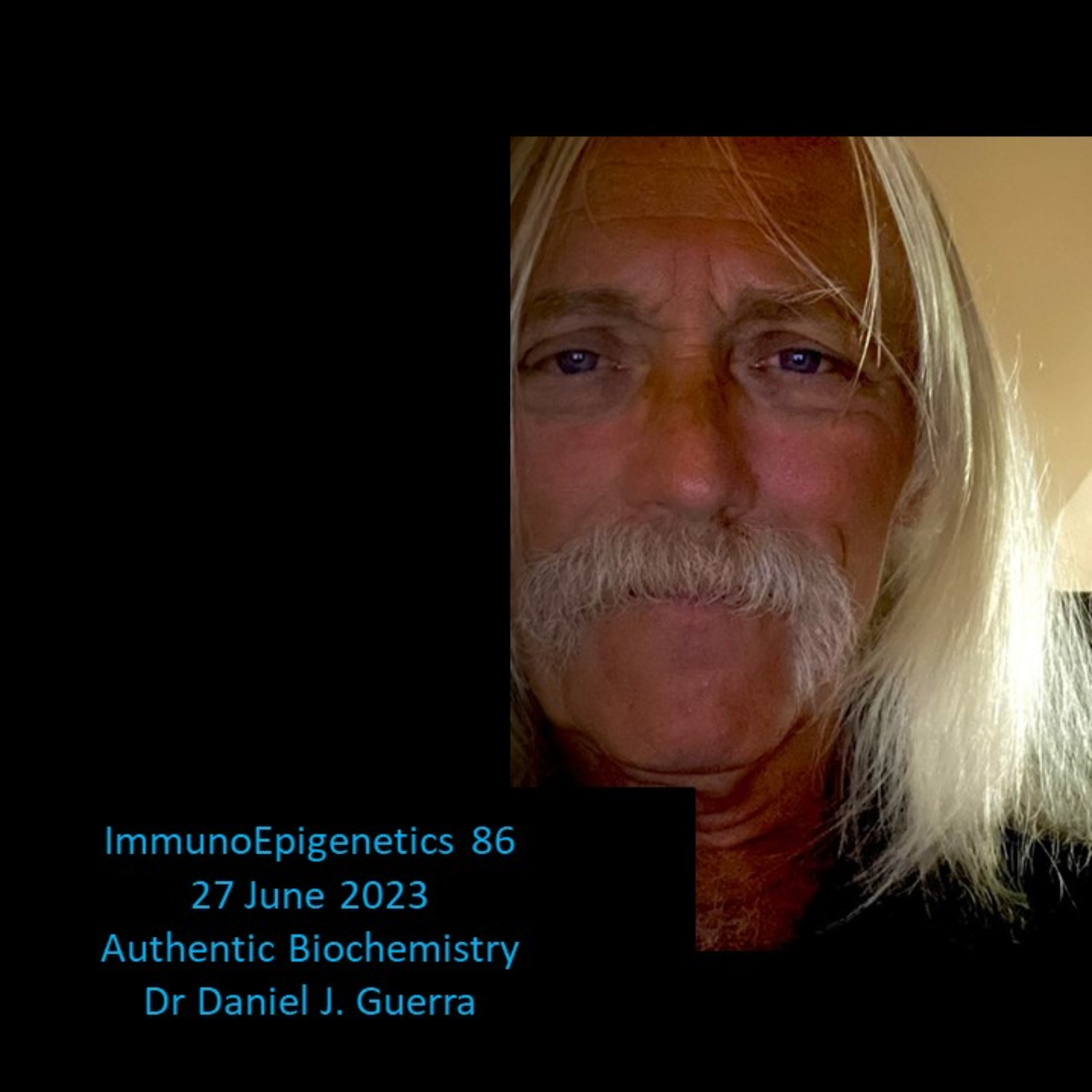 ImmunoEpigenetics86. Could regimented titrating statin pharmacotherapy be useful in controlling early T lymphoid progenitor cell ETP-ALL via an epigenetic mechansim? DJGPhD.27.6.23. Authentic Biochem