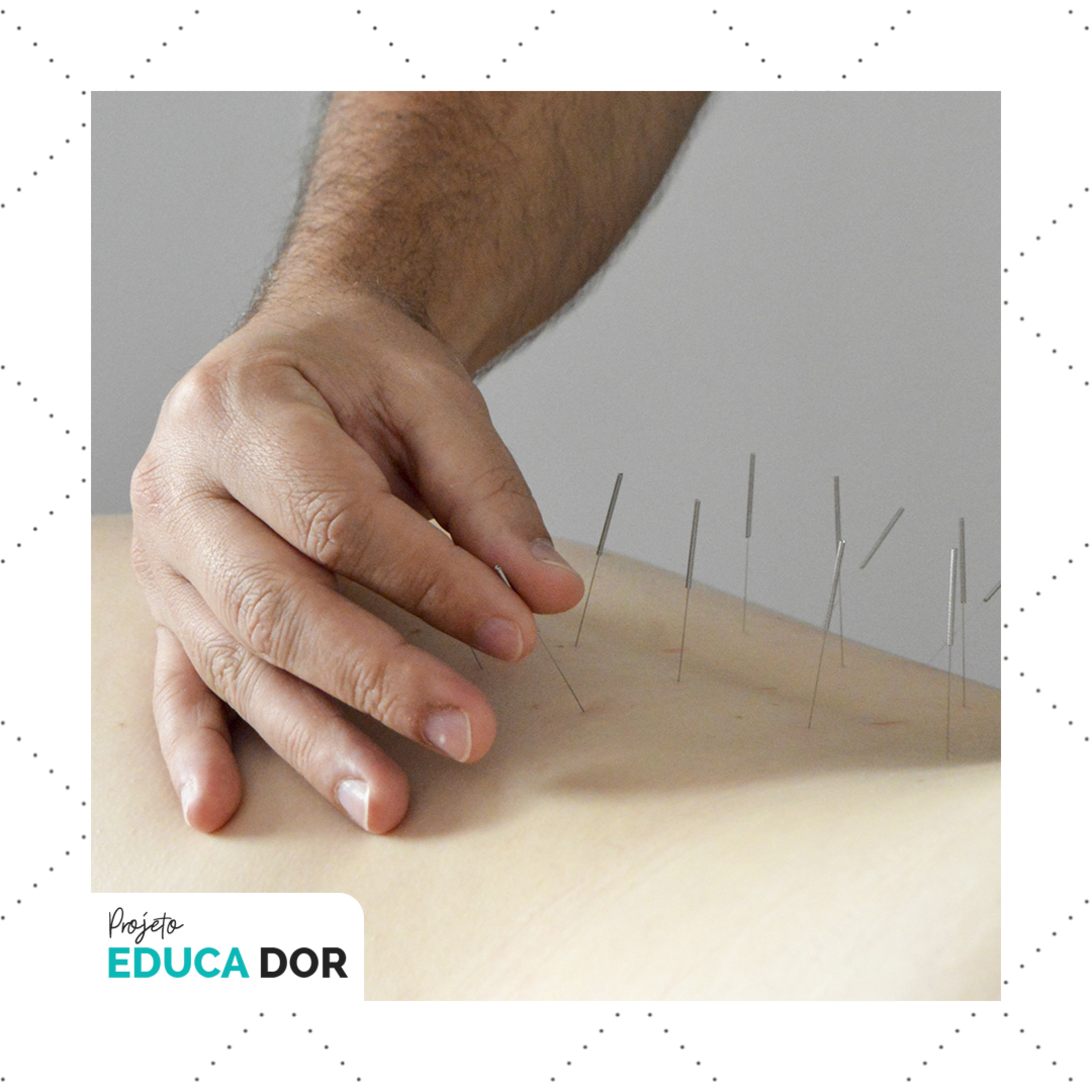 Acupuntura no tratamento da dor crônica