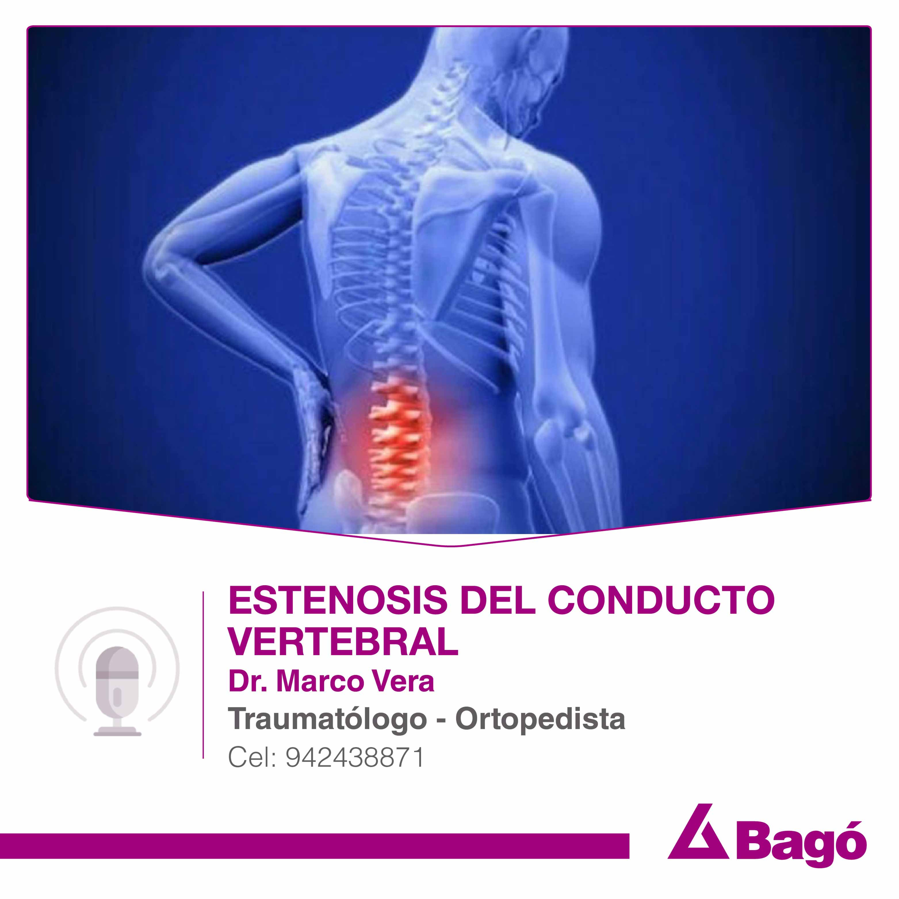 ESTENOSIS DEL CONDUCTO VERTEBRAL episode artwork