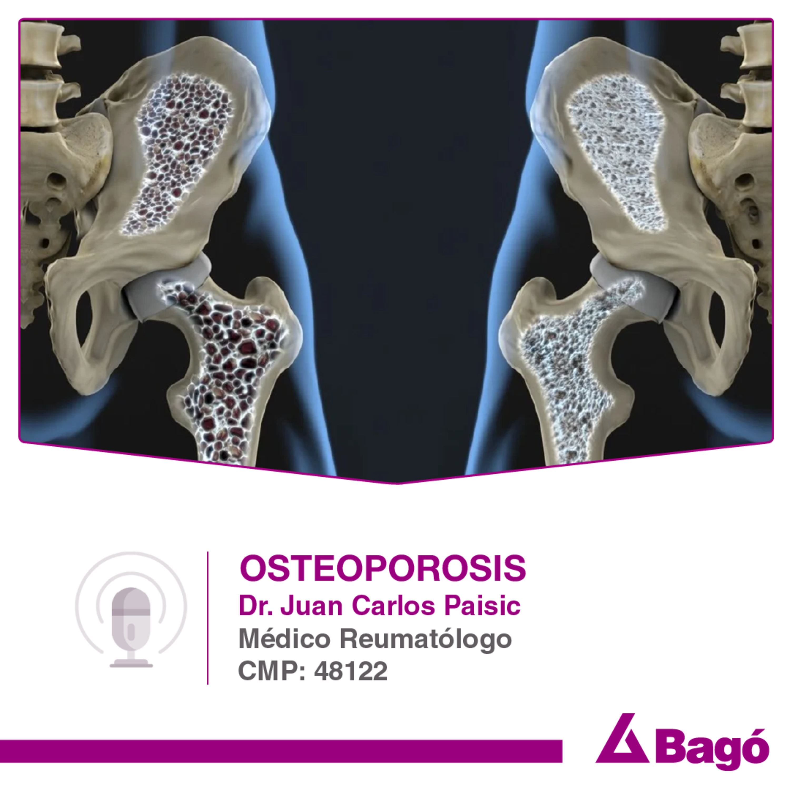 COMPRENDIENDO LA OSTEOPOROSIS: IMPACTO, FACTORES DE RIESGO Y TRATAMIENTOS episode artwork