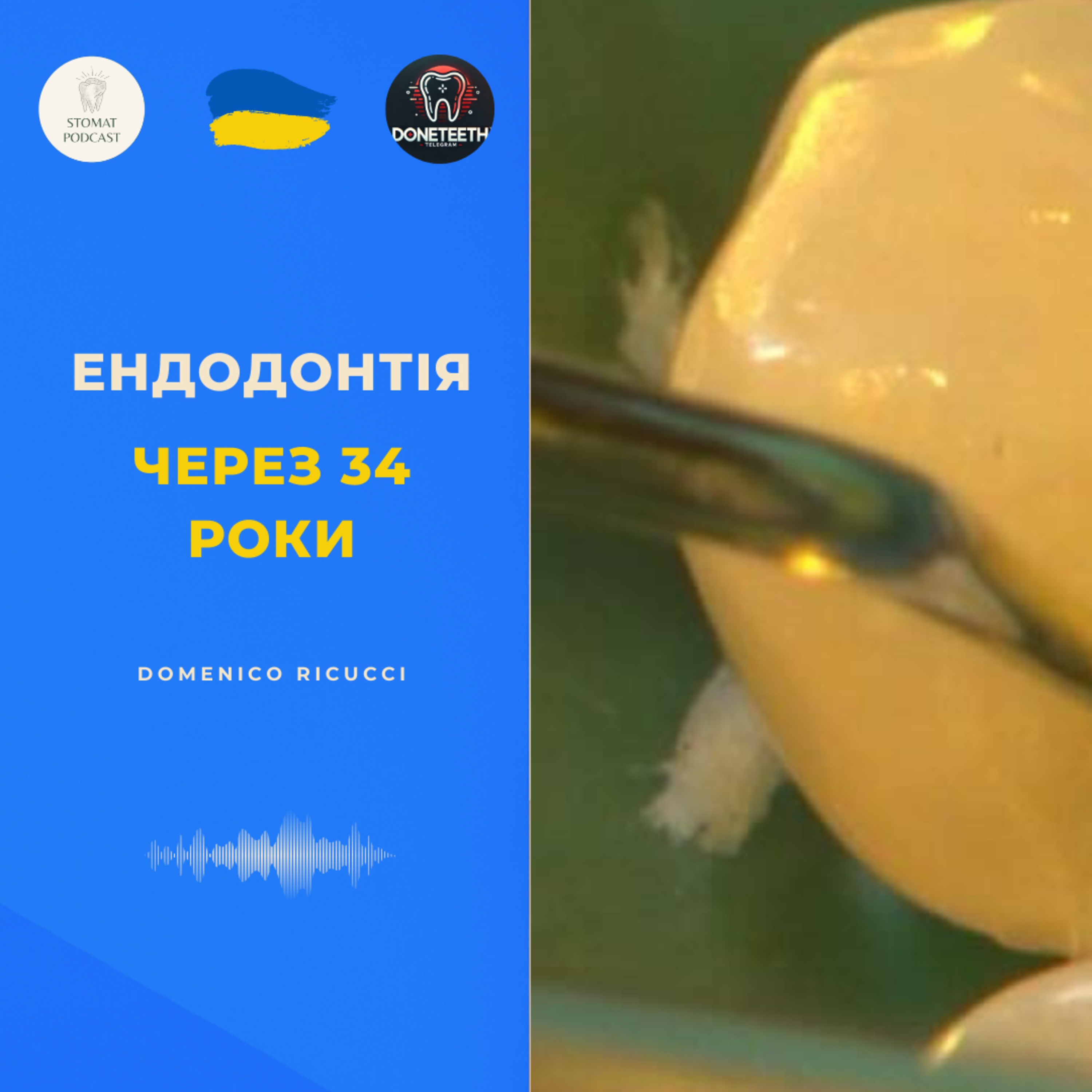 Ендодонтія через 34 роки