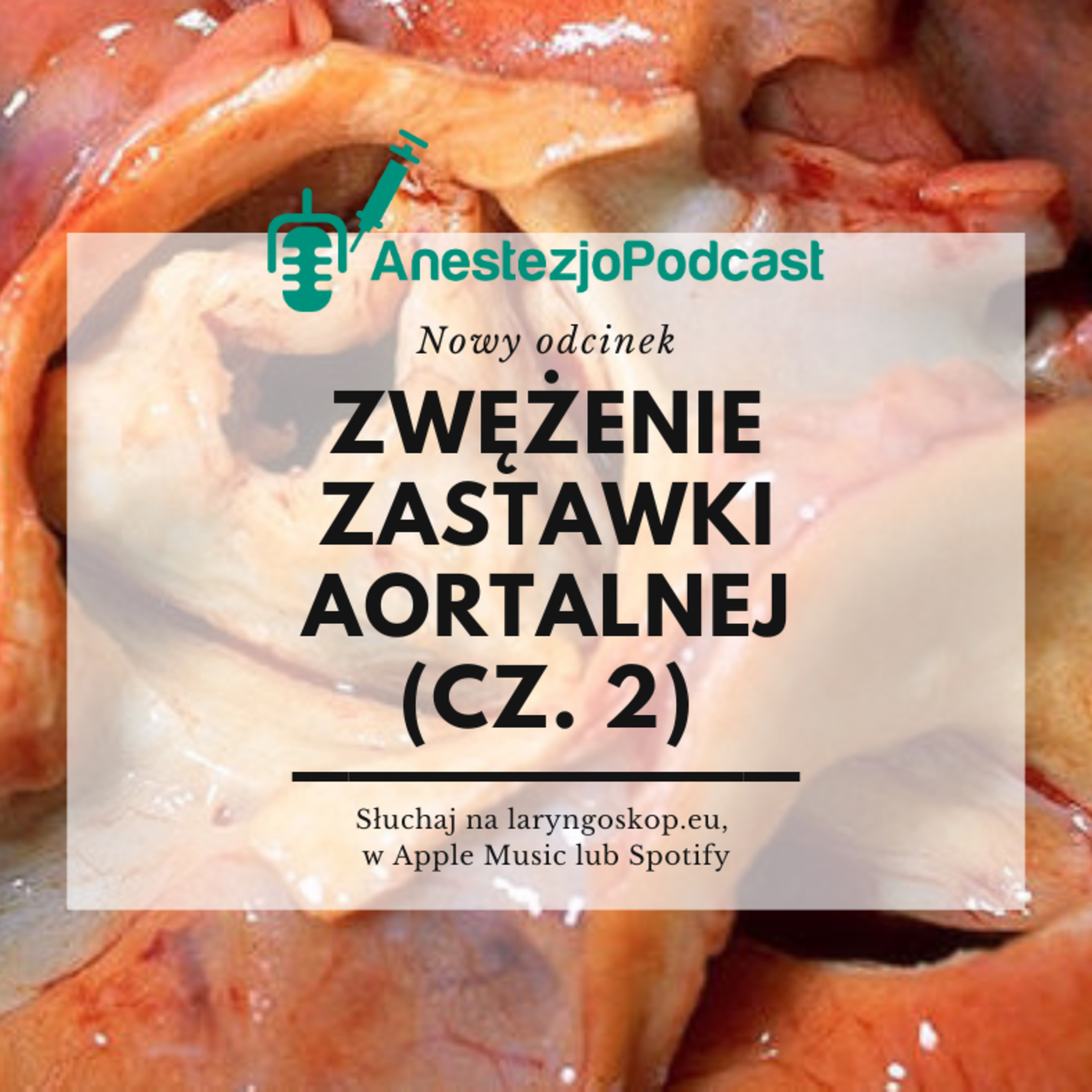 Odcinek 91 - Zwężenie zastawki aortalnej (cz. 2)