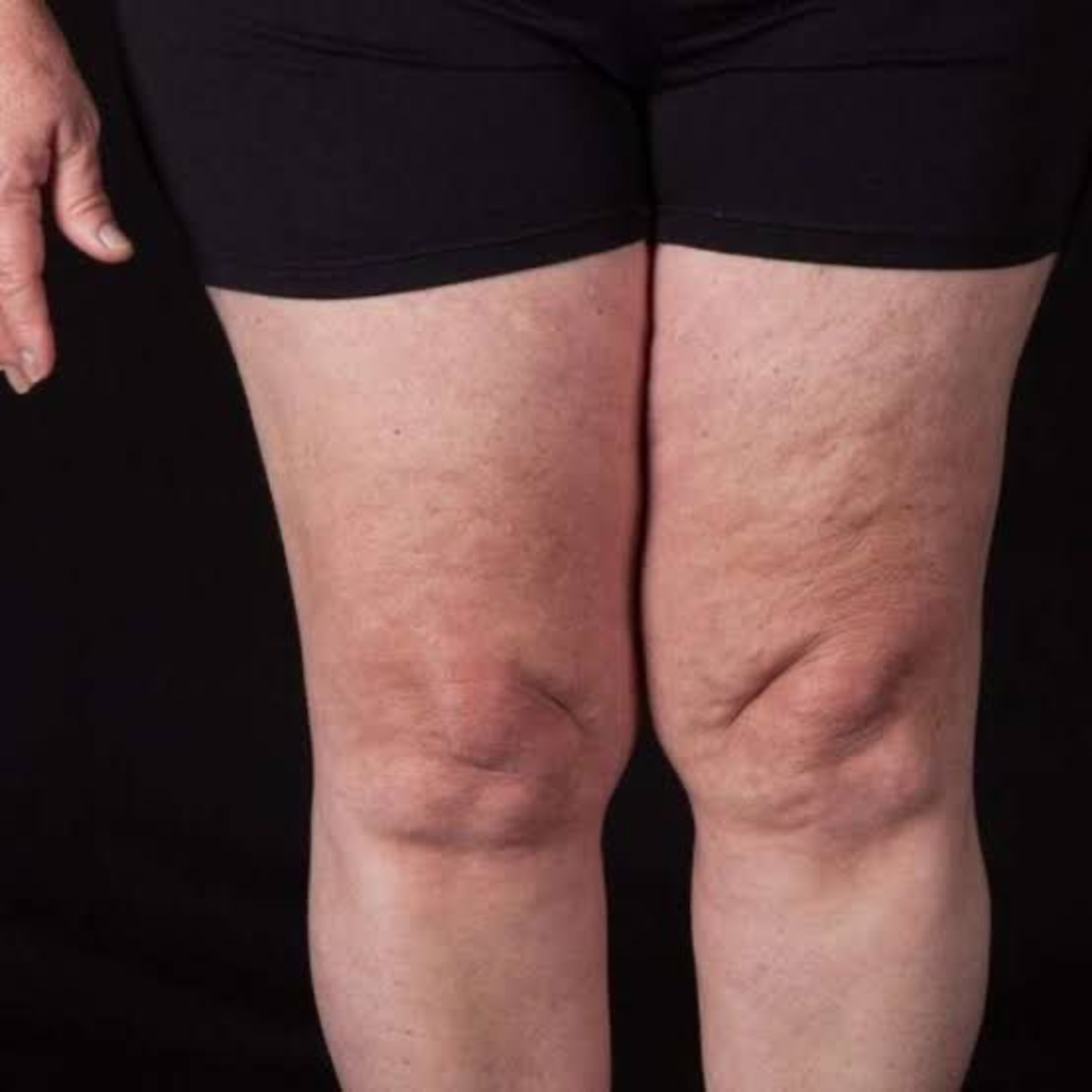 Lipedema: a doença da gordura dolorosa