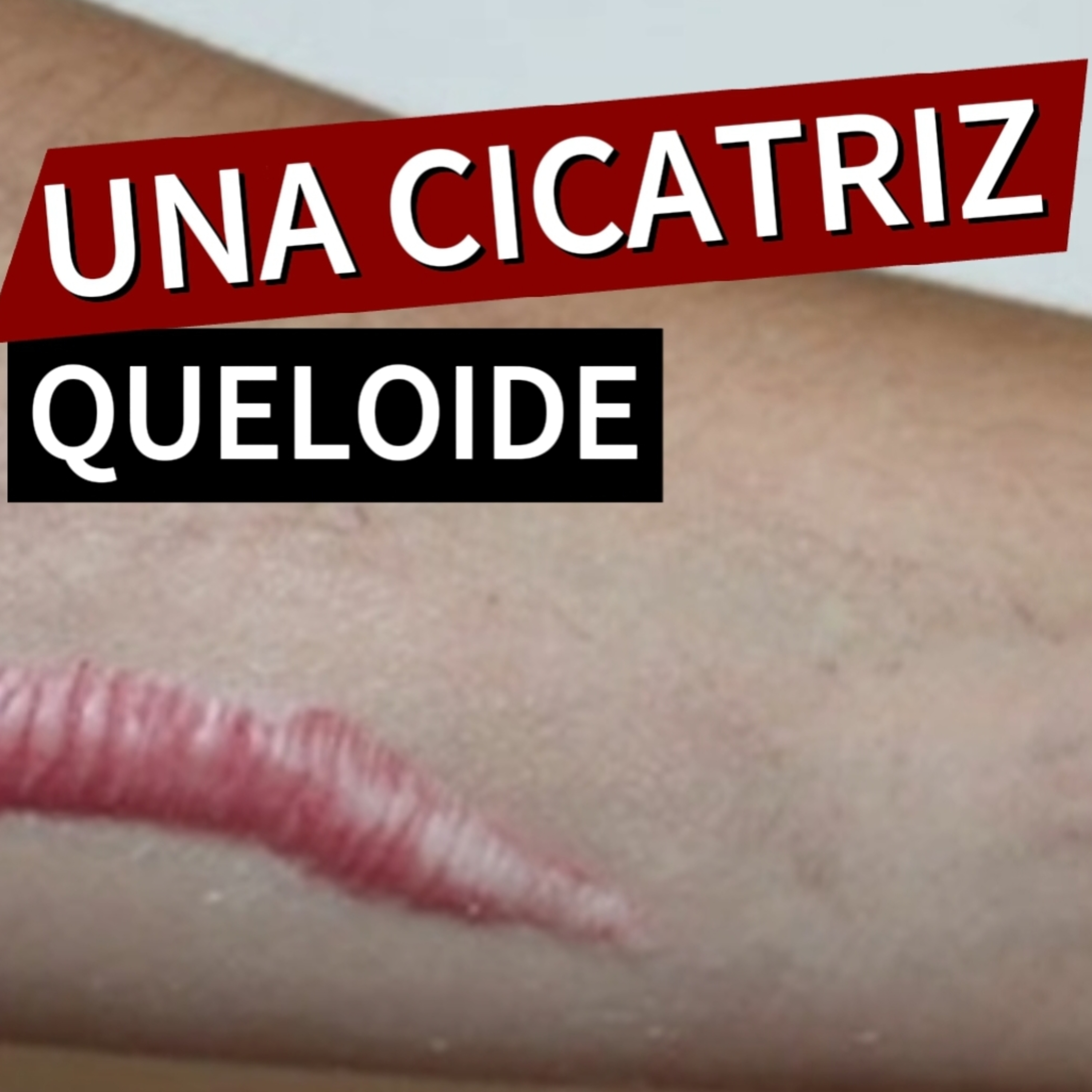 #4 🪙"UNA CICATRIZ QUELOIDE"👁️Que es y porue sale?⭐Sigue LA SERIE en YOUTUBE/NoeLopezOficial  episode artwork