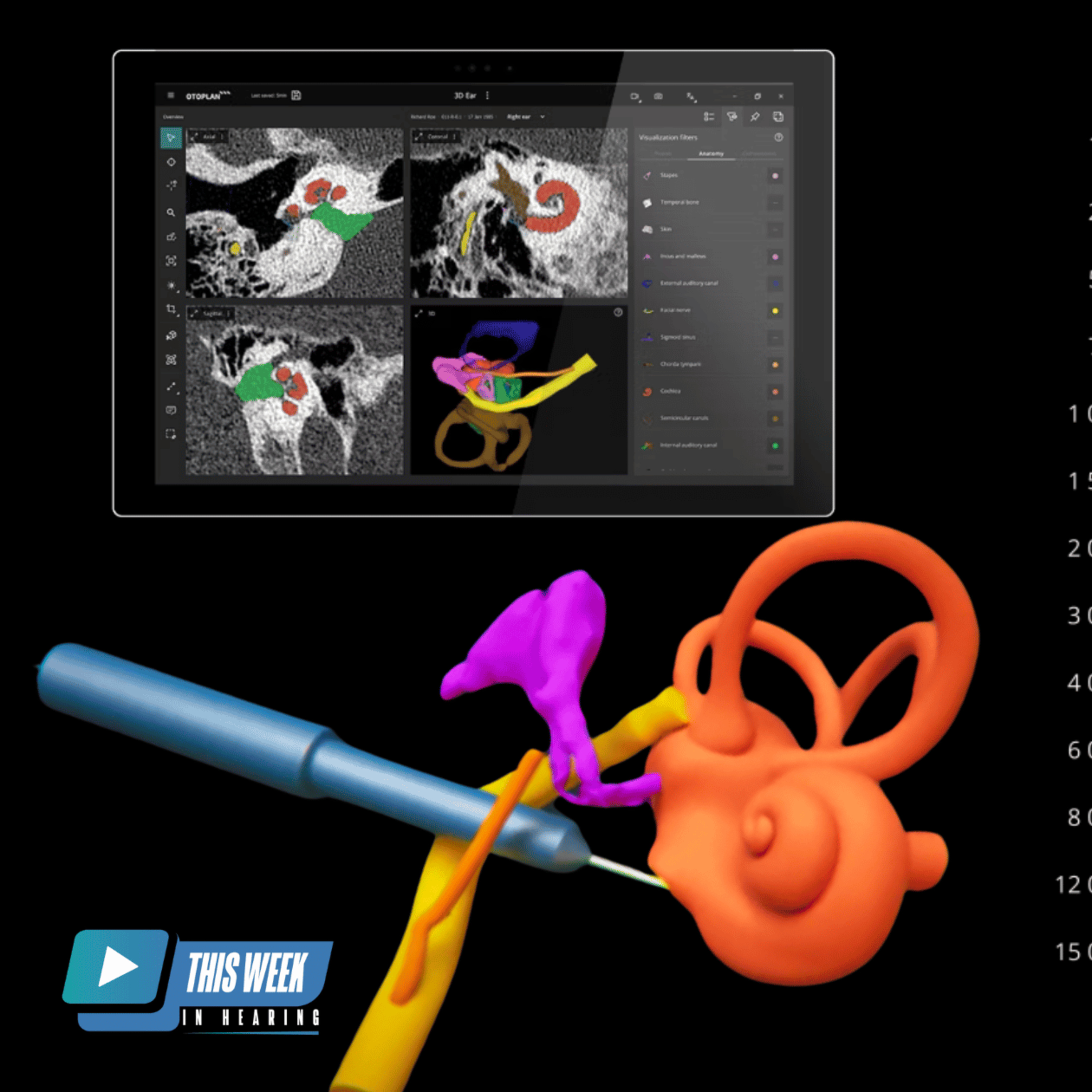 241 - Inside OTOPLAN: MED-EL’s Innovative Tool for Optimizing Cochlear Implant Results episode artwork