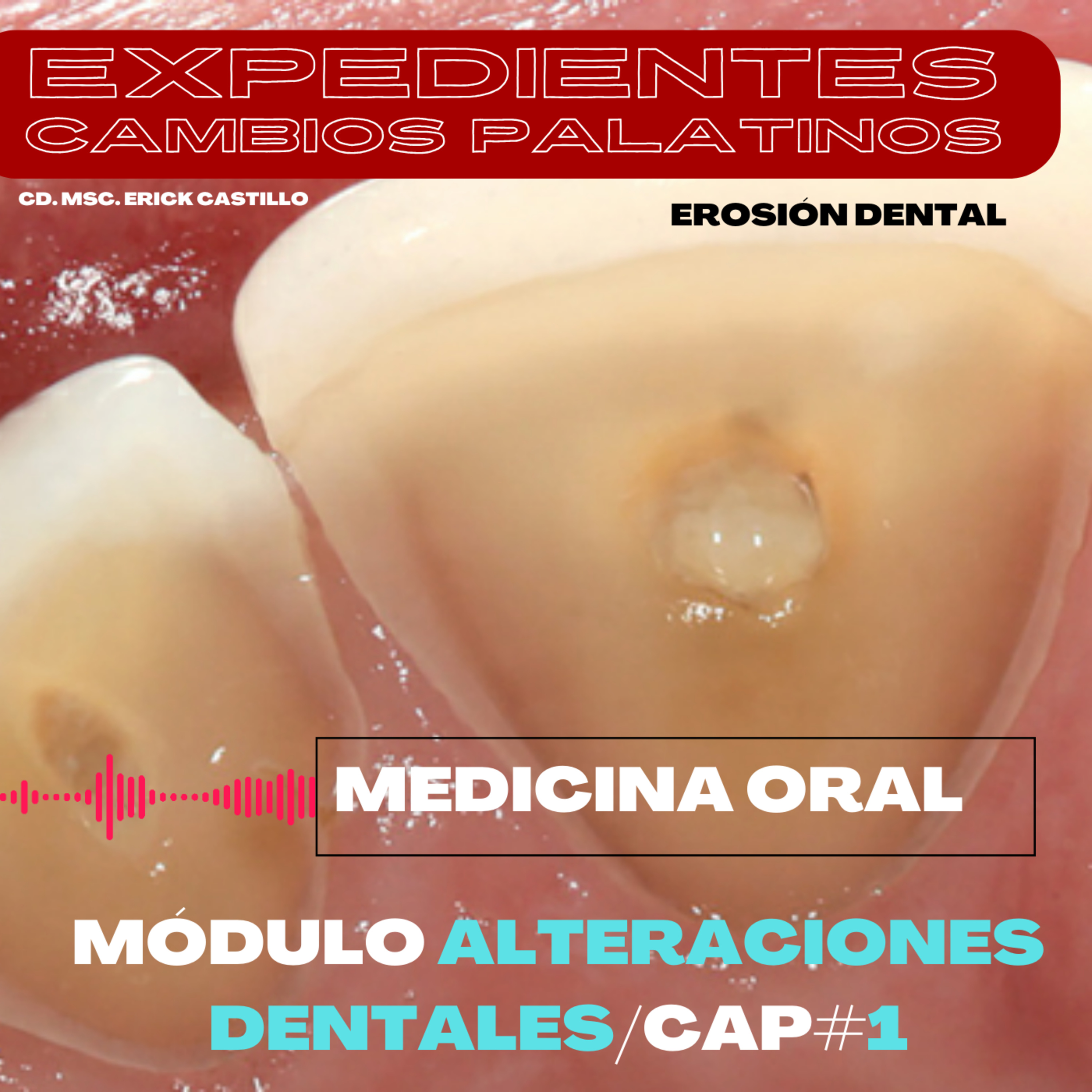 Erosión dental por anorexia o bulimia/Cáp. #1 episode artwork