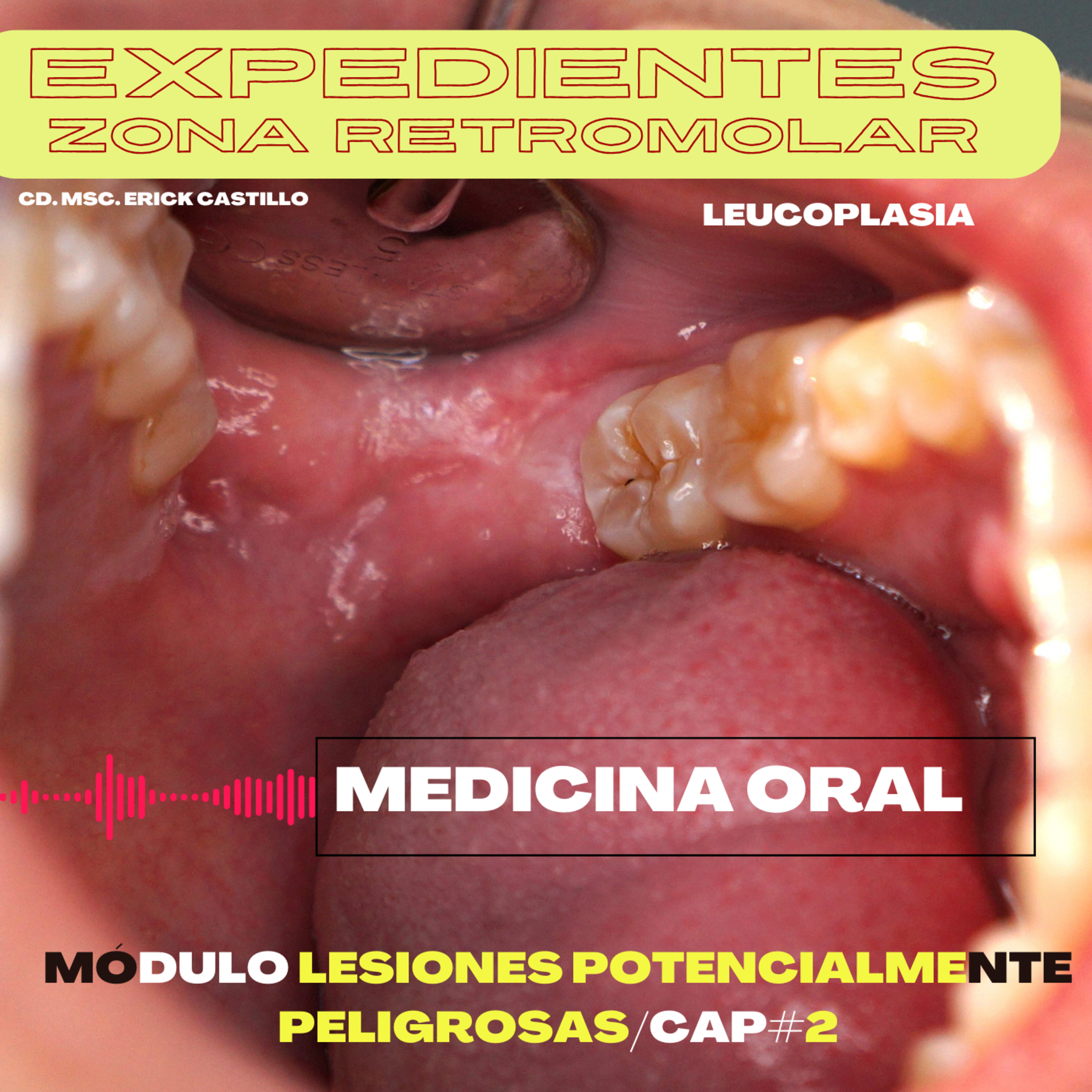 Leucoplasia oral /Cáp. # 2 episode artwork
