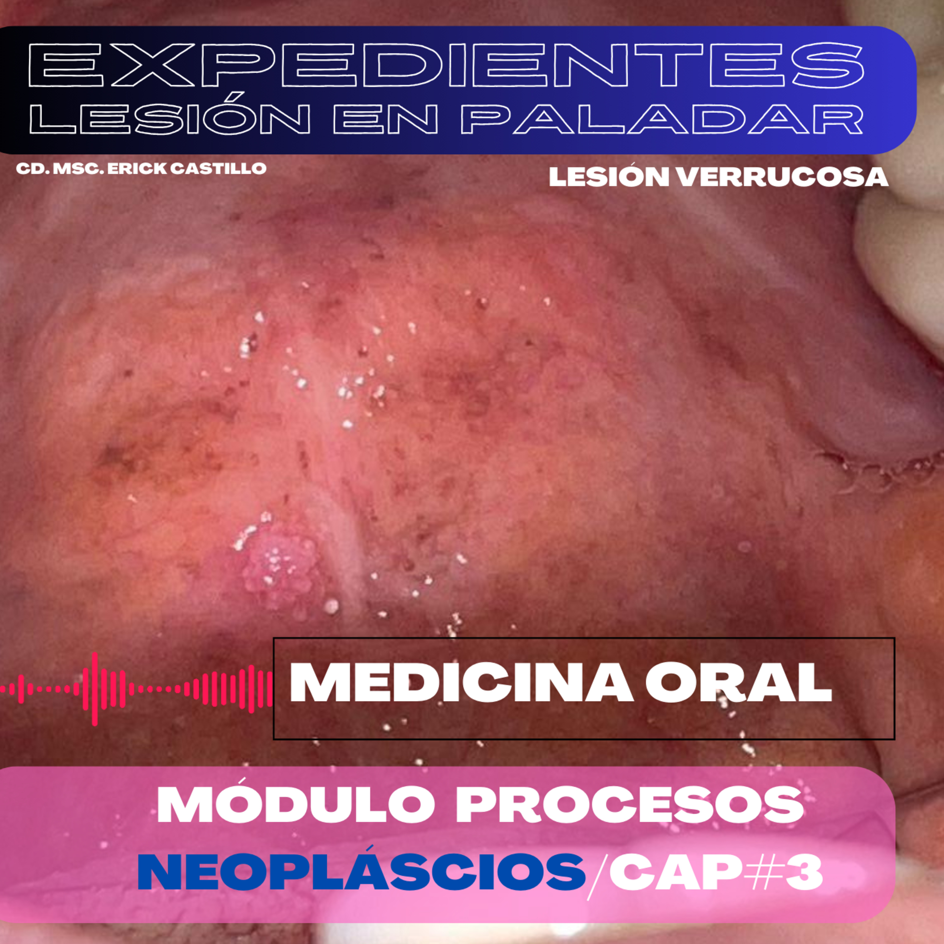 Lesión verrucosa en el paladar blanco/Cáp. #3 episode artwork