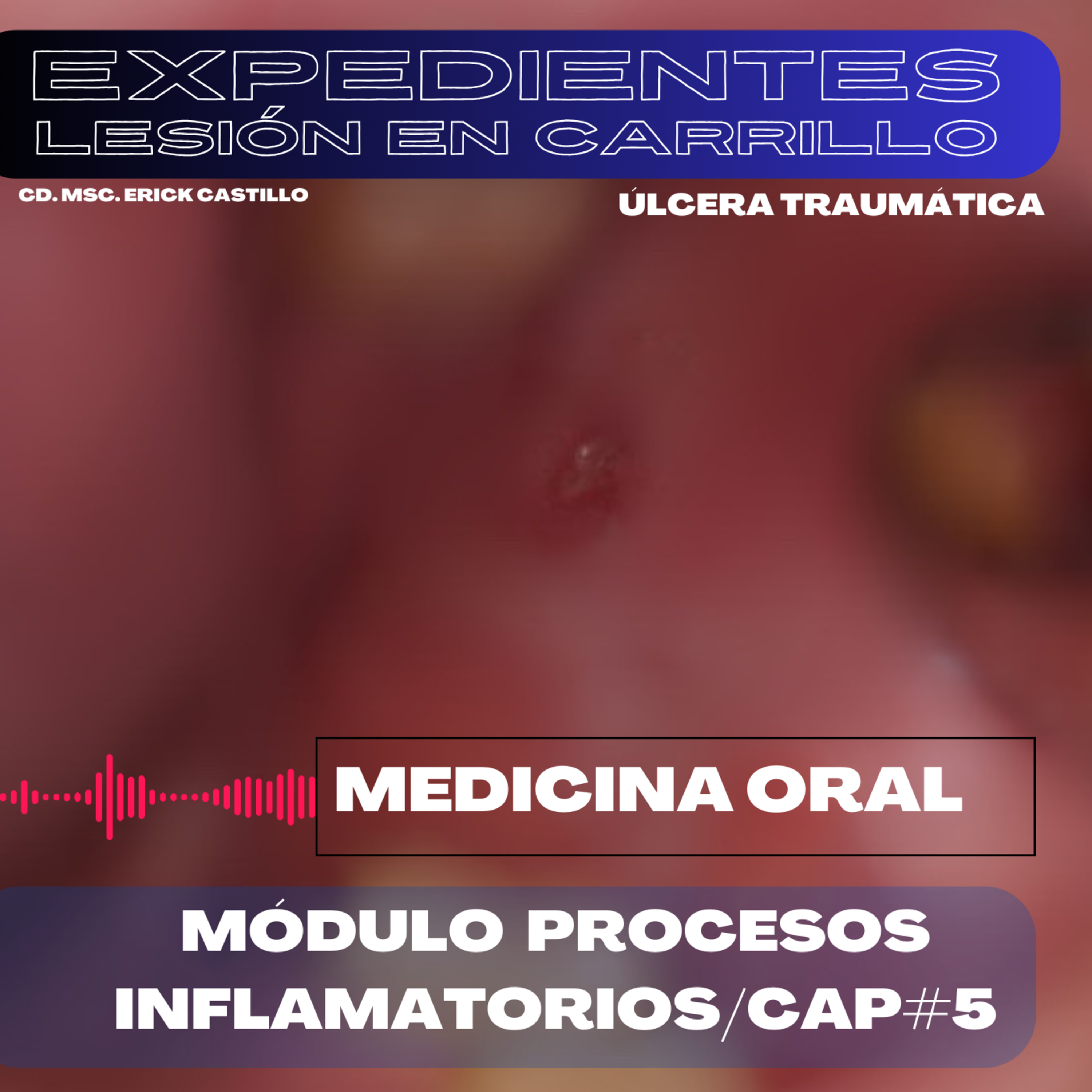 Ulcera traumática oral /Cáp. # 5 episode artwork