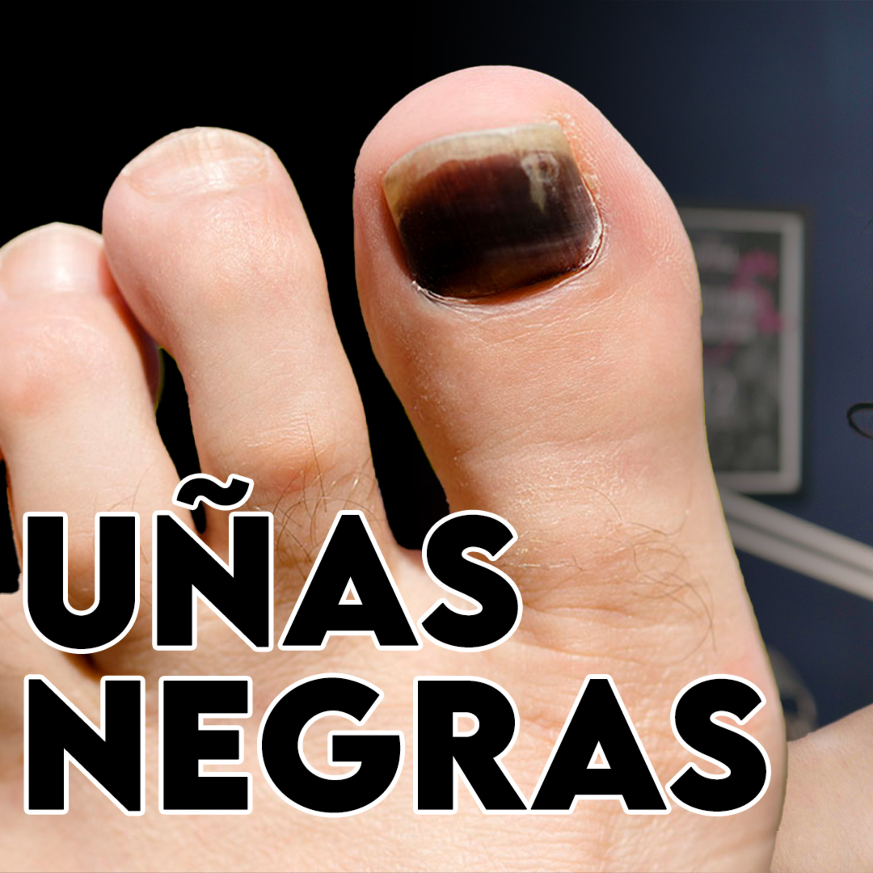 UÑAS NEGRAS al Correr o Hiking: Por Qué, Cómo Curarlas y Evitarlas PARA SIEMPRE | Corre Fer Corre