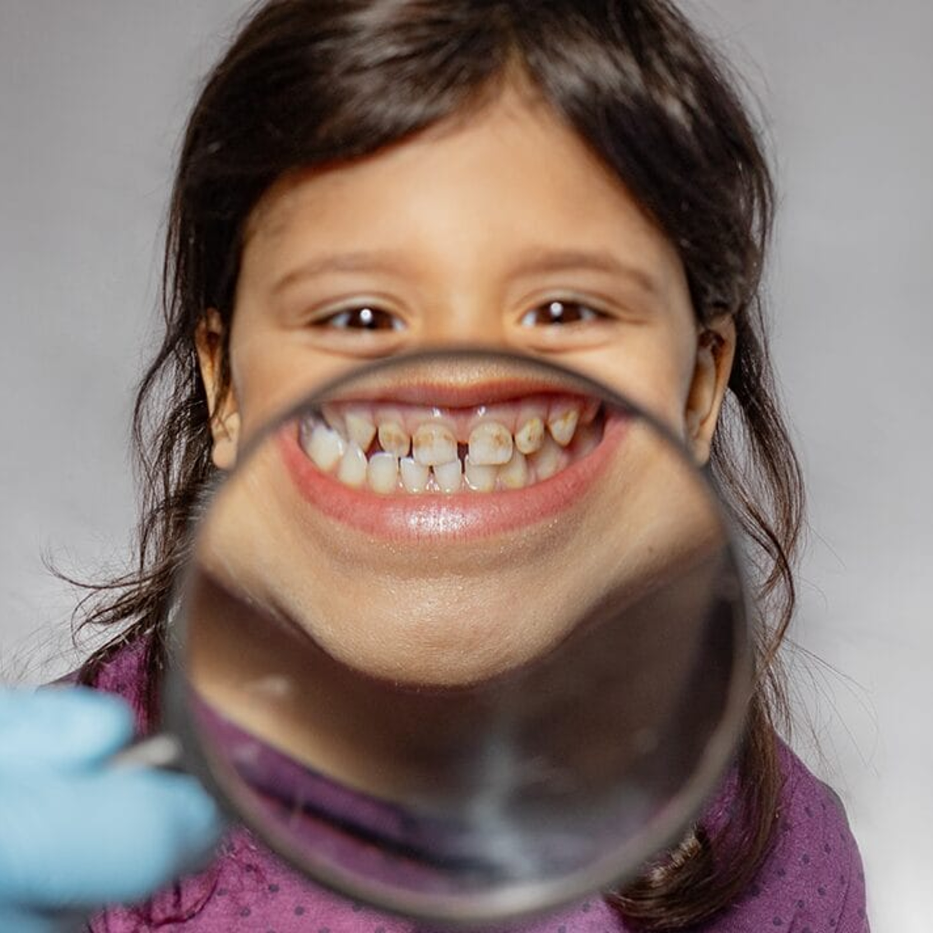 Audio Article: Systematic Review Evaluates the Global Prevalence of Dental Caries Among Racially Minoritized Children