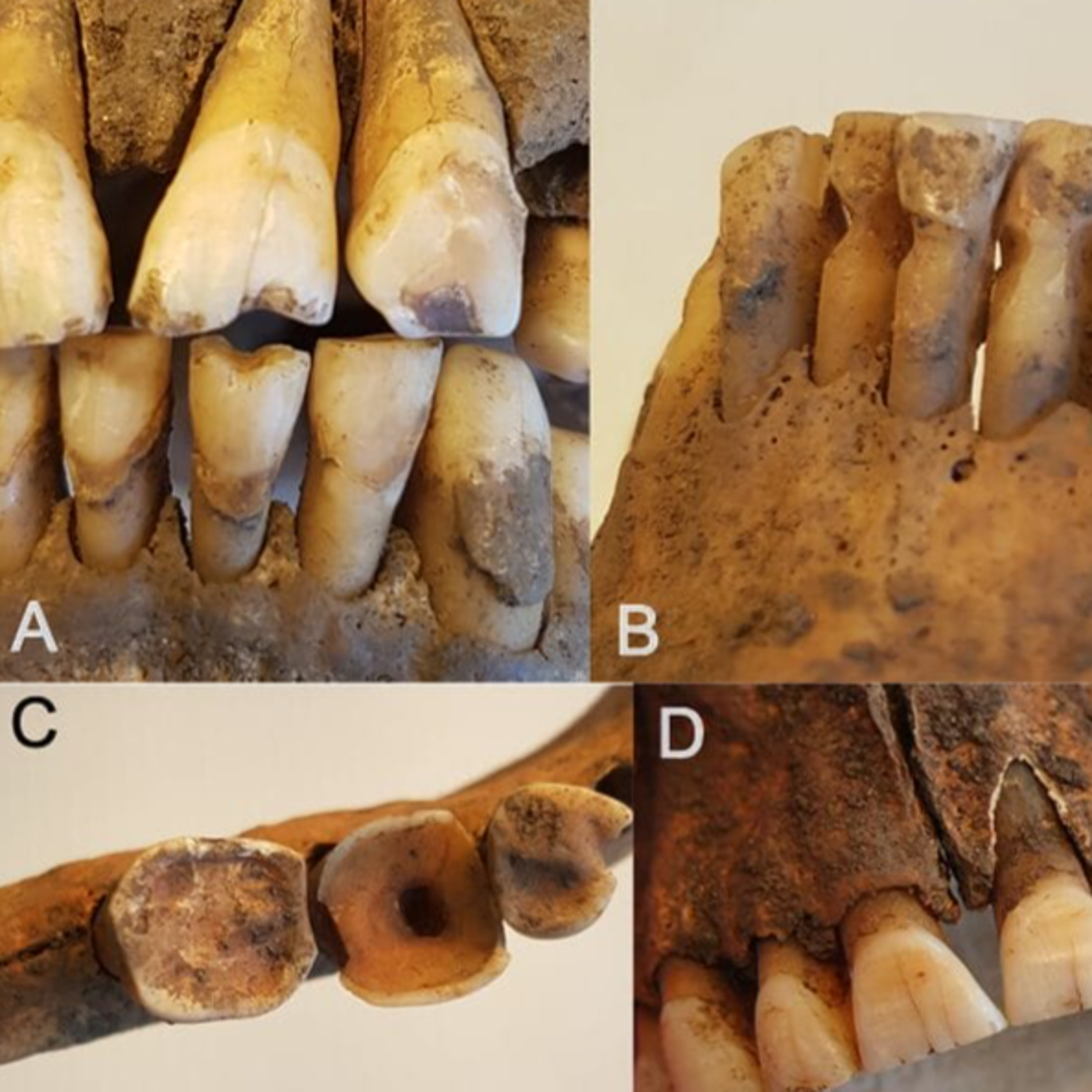 Audio Article: Researchers Find that Viking Age Dentistry Was Probably More Sophisticated than Previously Thought