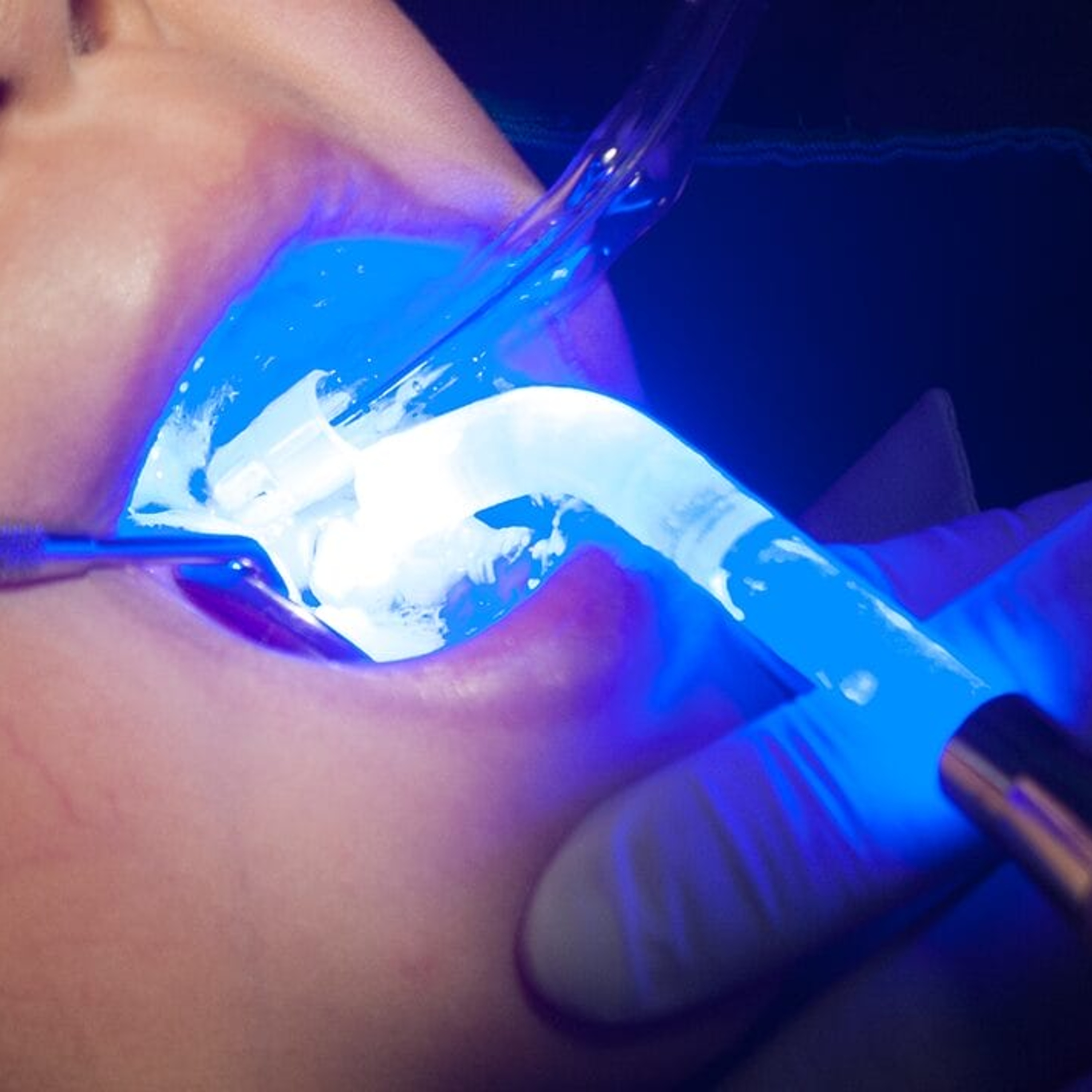 Audio Article: Researchers Compare Silver Diamine Fluoride vs Sealants for Community-Based Dental Caries Prevention