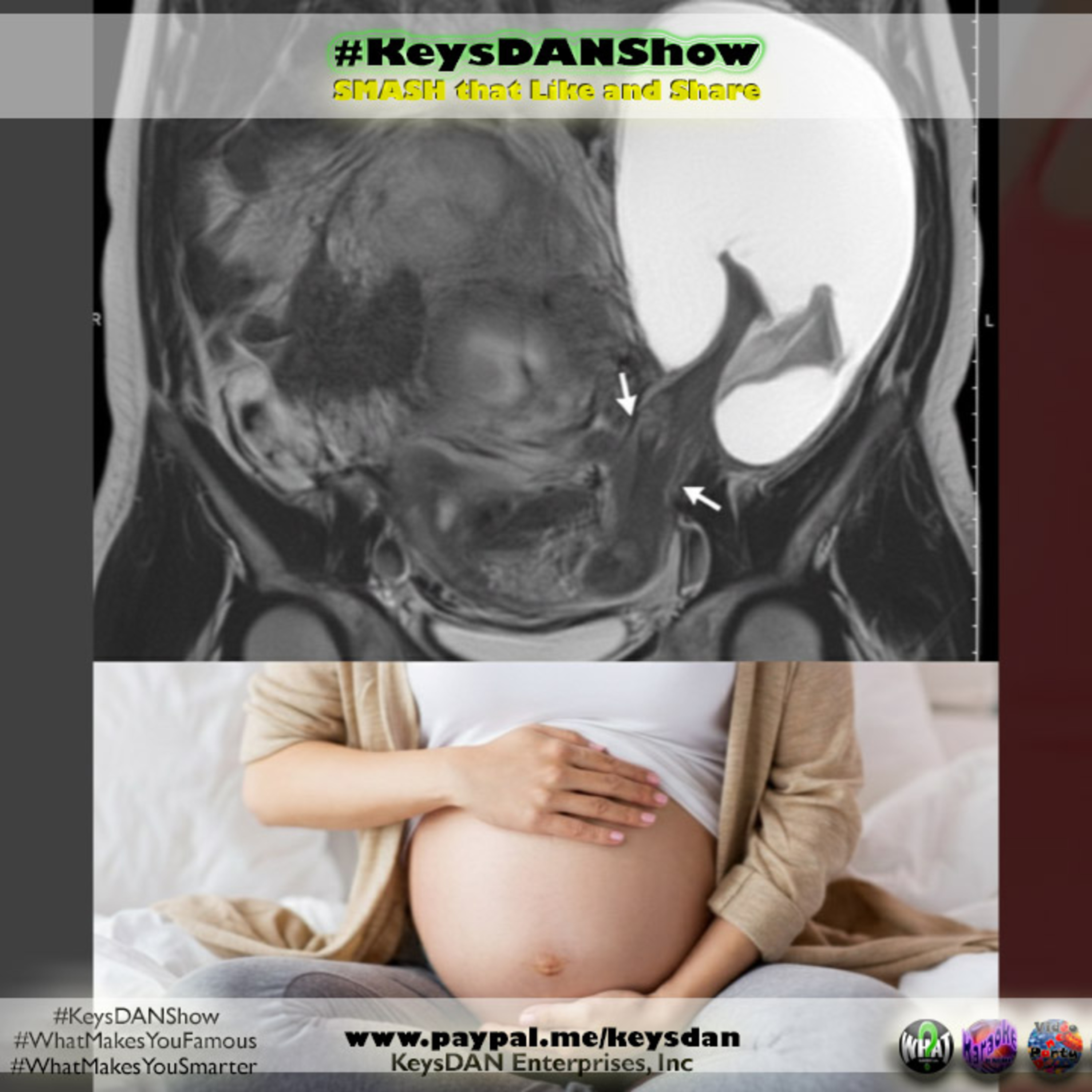 Pregnant Woman's 6th Child: Life-Threatening Uterine Defect Found KeysDAN Show #Science #KeysDANShow @KeysDAN episode artwork