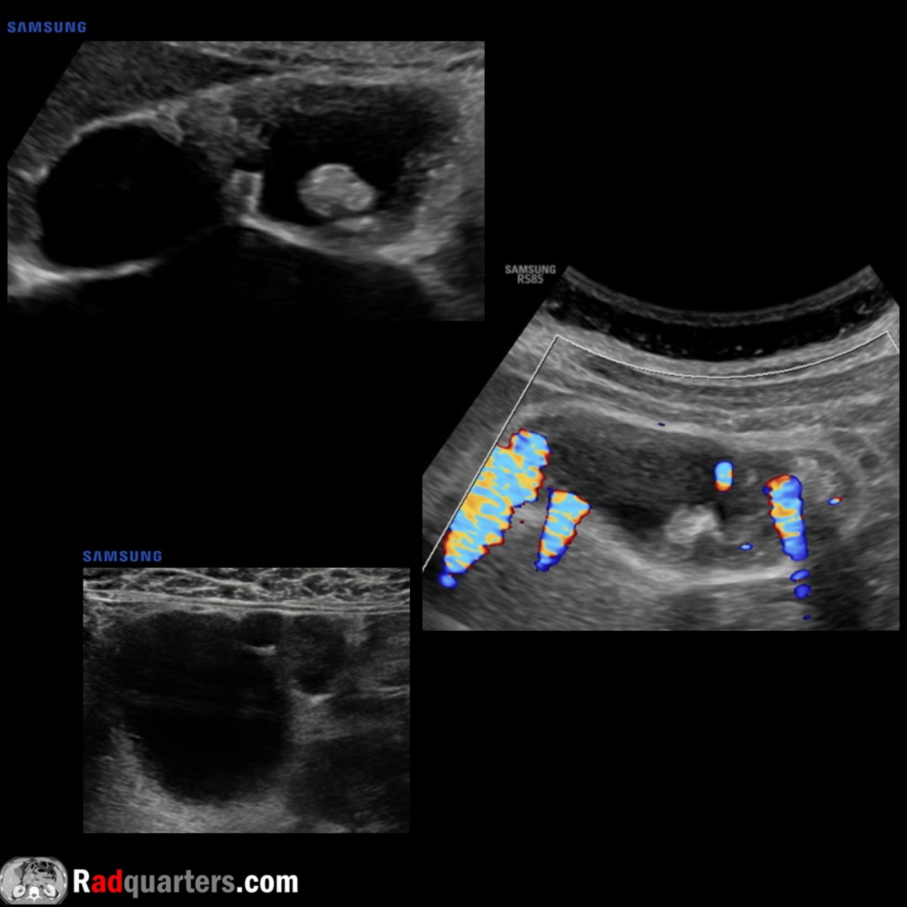 Ultrasound of Gallbladder Adenomyomatosis episode artwork
