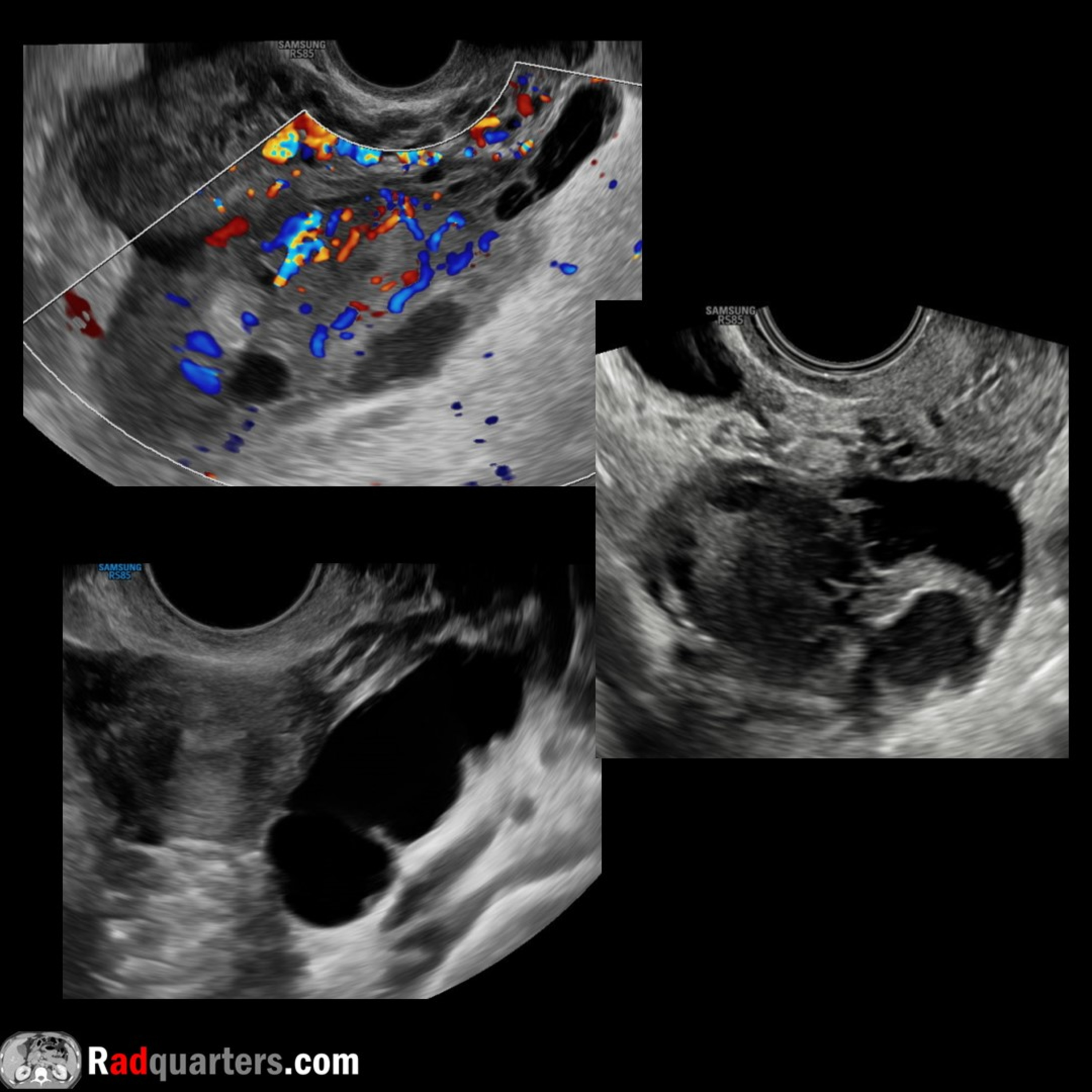 Ultrasound of Hydrosalpinx, Pyosalpinx & Tubo-ovarian Abscess episode artwork