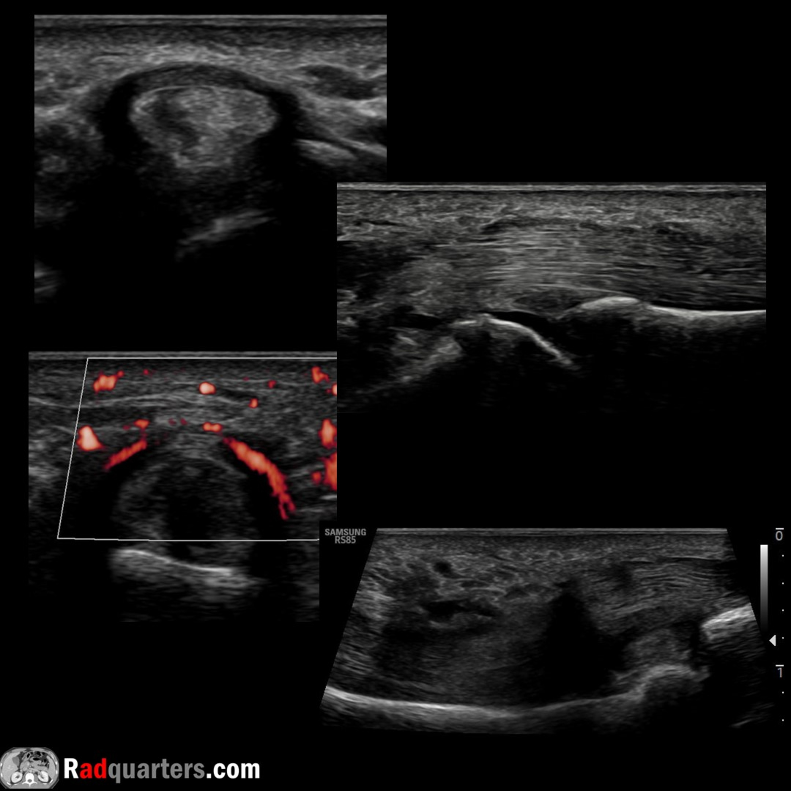 Ultrasound of Trigger Finger (Stenosing Tenosynovitis) episode artwork