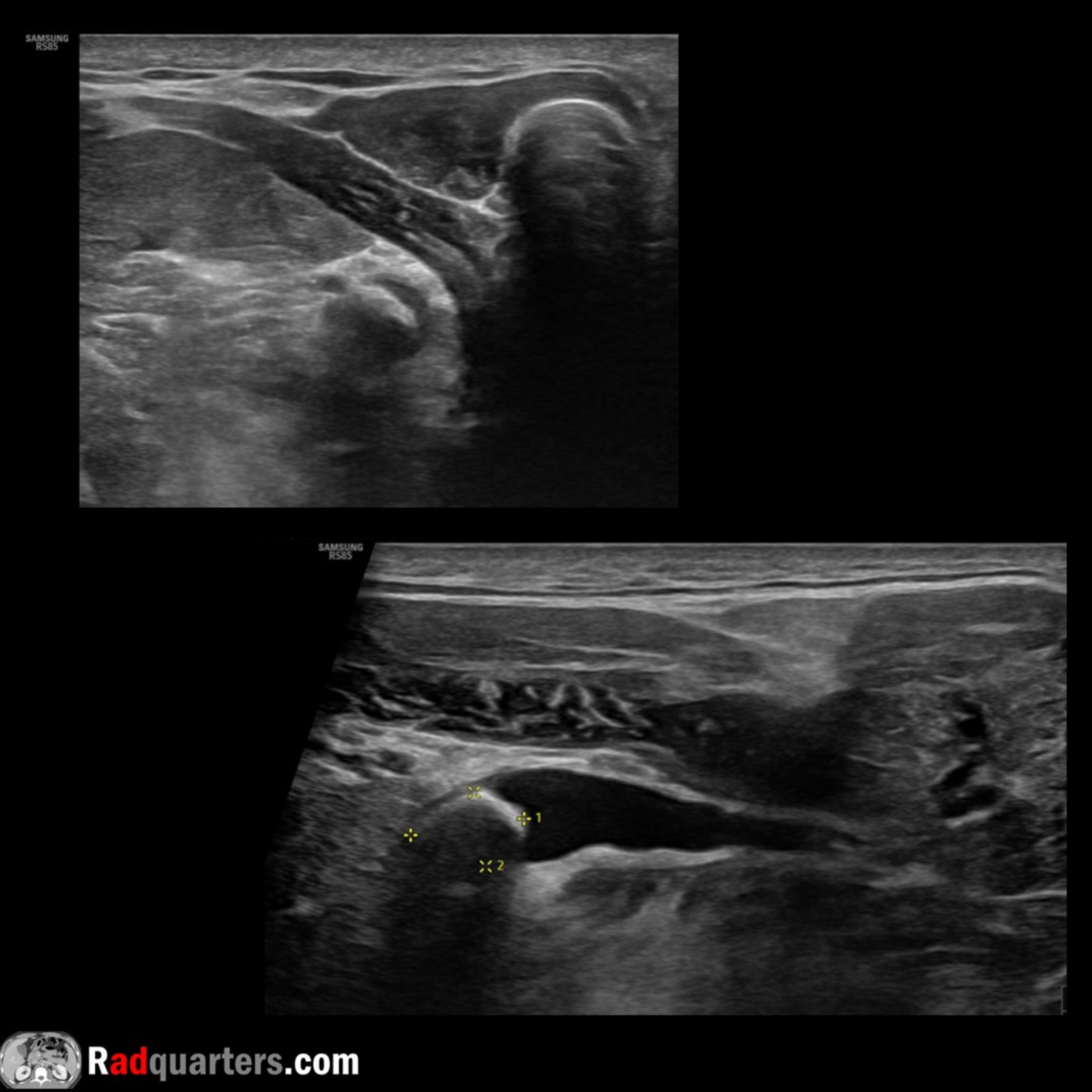 Ultrasound of Submandibular Sialolithiasis (Salivary Stones) episode artwork