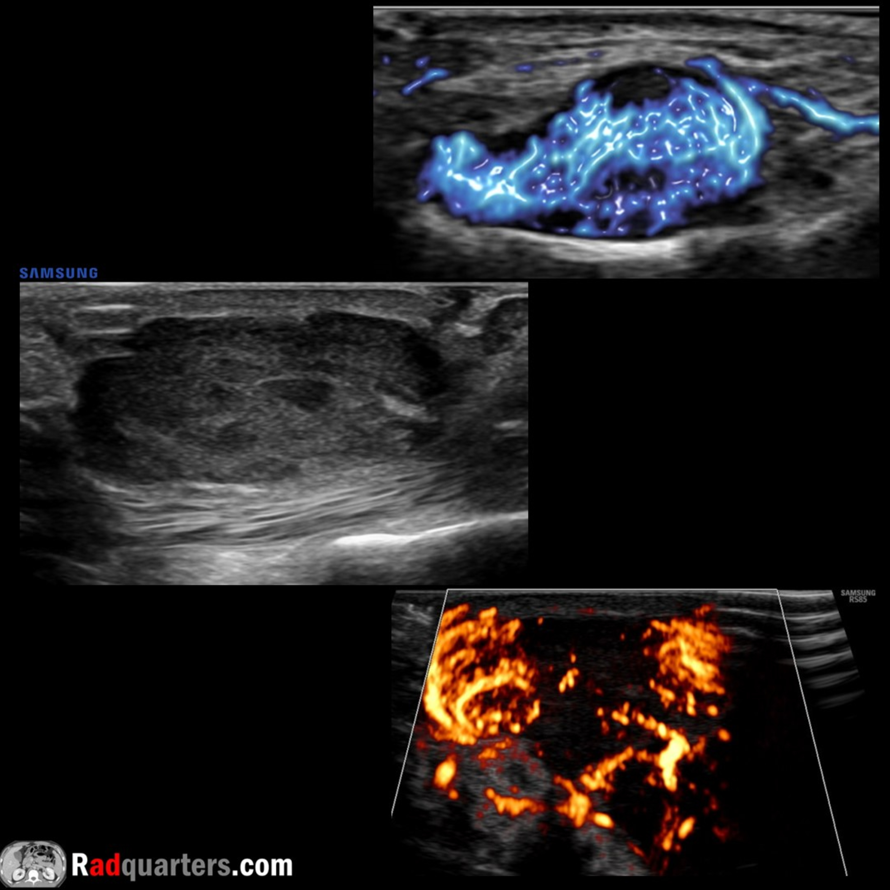 Ultrasound of Giant Cell Tumor of the Tendon Sheath episode artwork