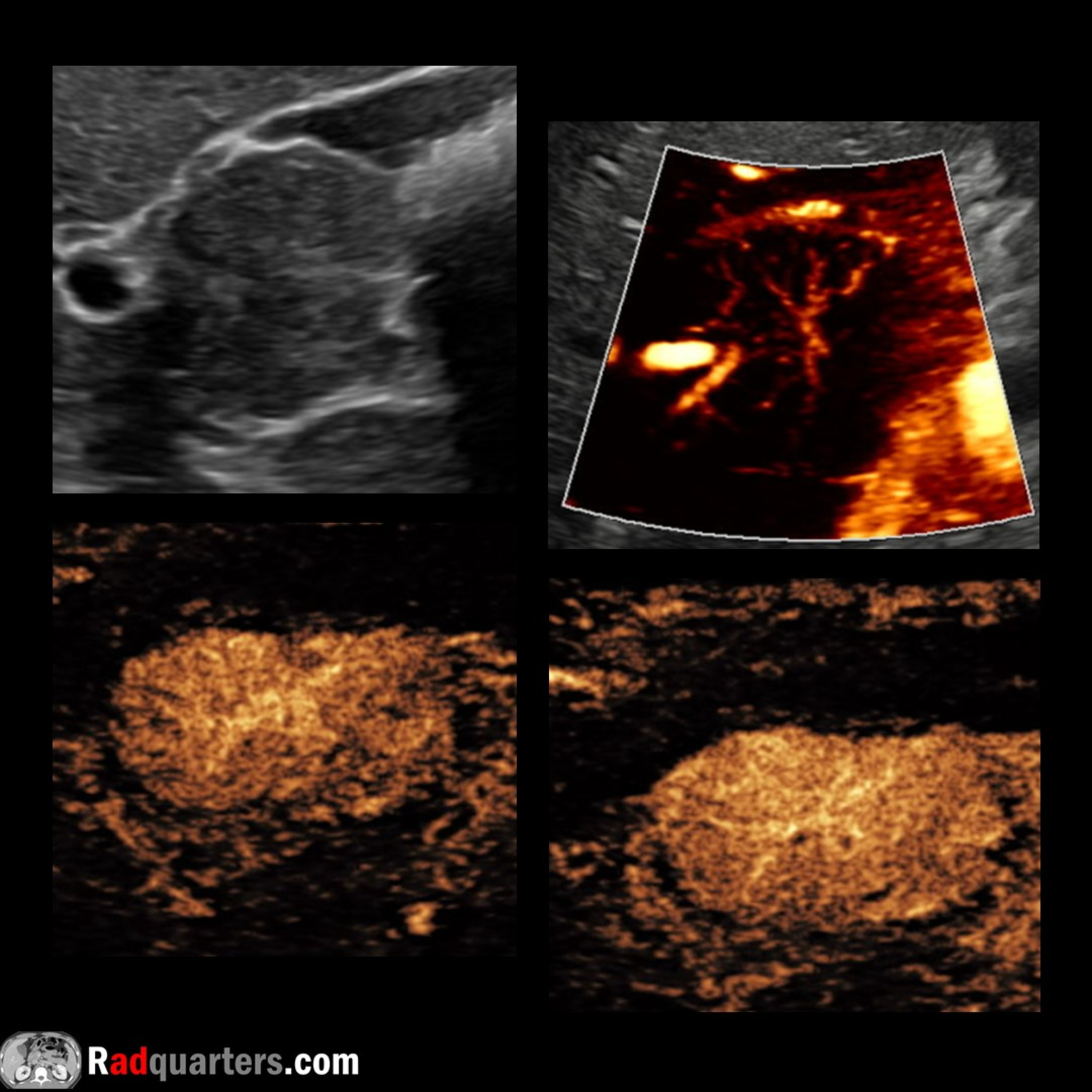 Contrast-Enhanced Ultrasound of Focal Nodular Hyperplasia episode artwork