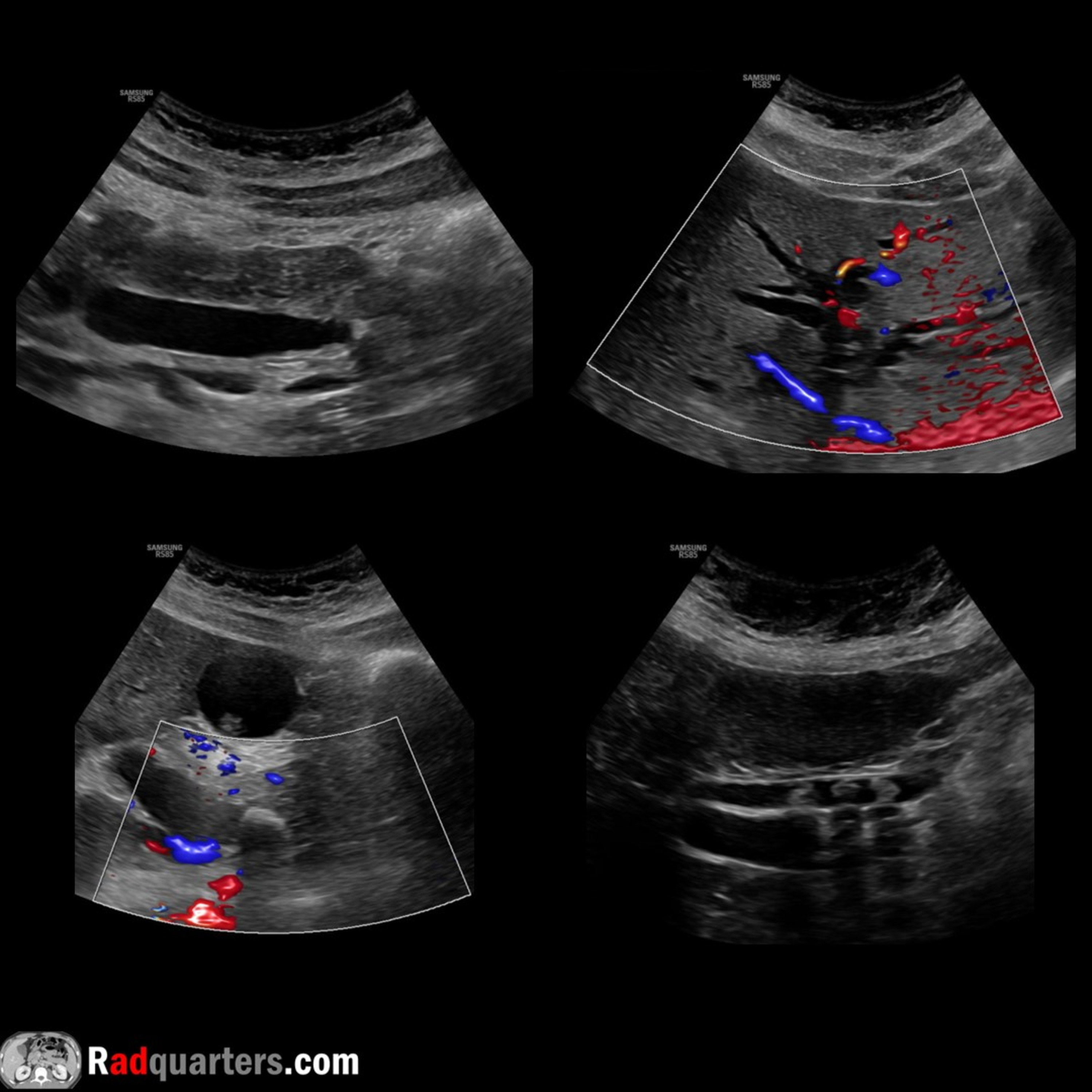 Ultrasound of Choledocholithiasis (Common Bile Duct Stones) episode artwork
