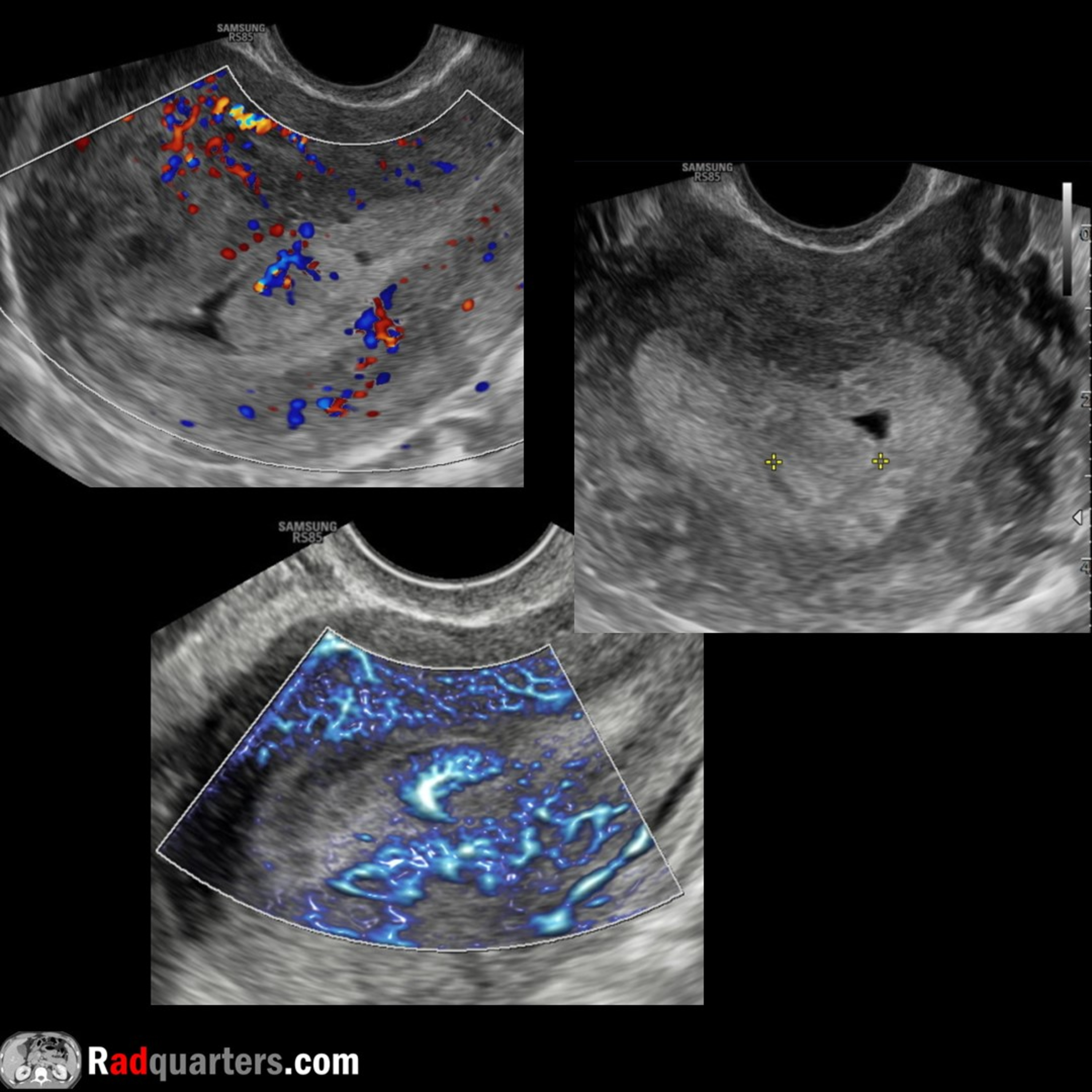 Ultrasound of Endometrial Polyps episode artwork