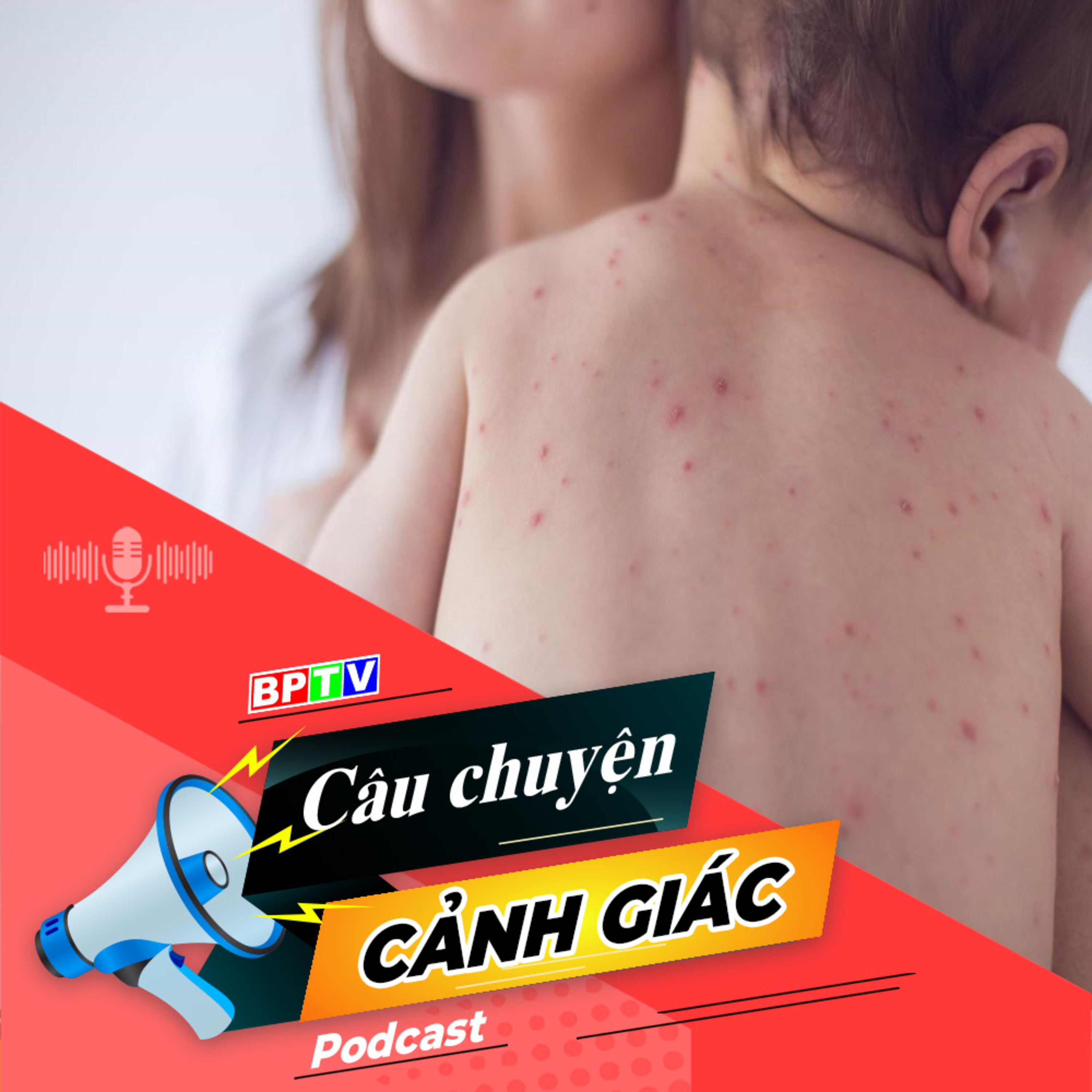 Cảnh giác với bệnh thủy đậu mùa đông xuân ở trẻ nhỏ | Câu chuyện cảnh giác episode artwork