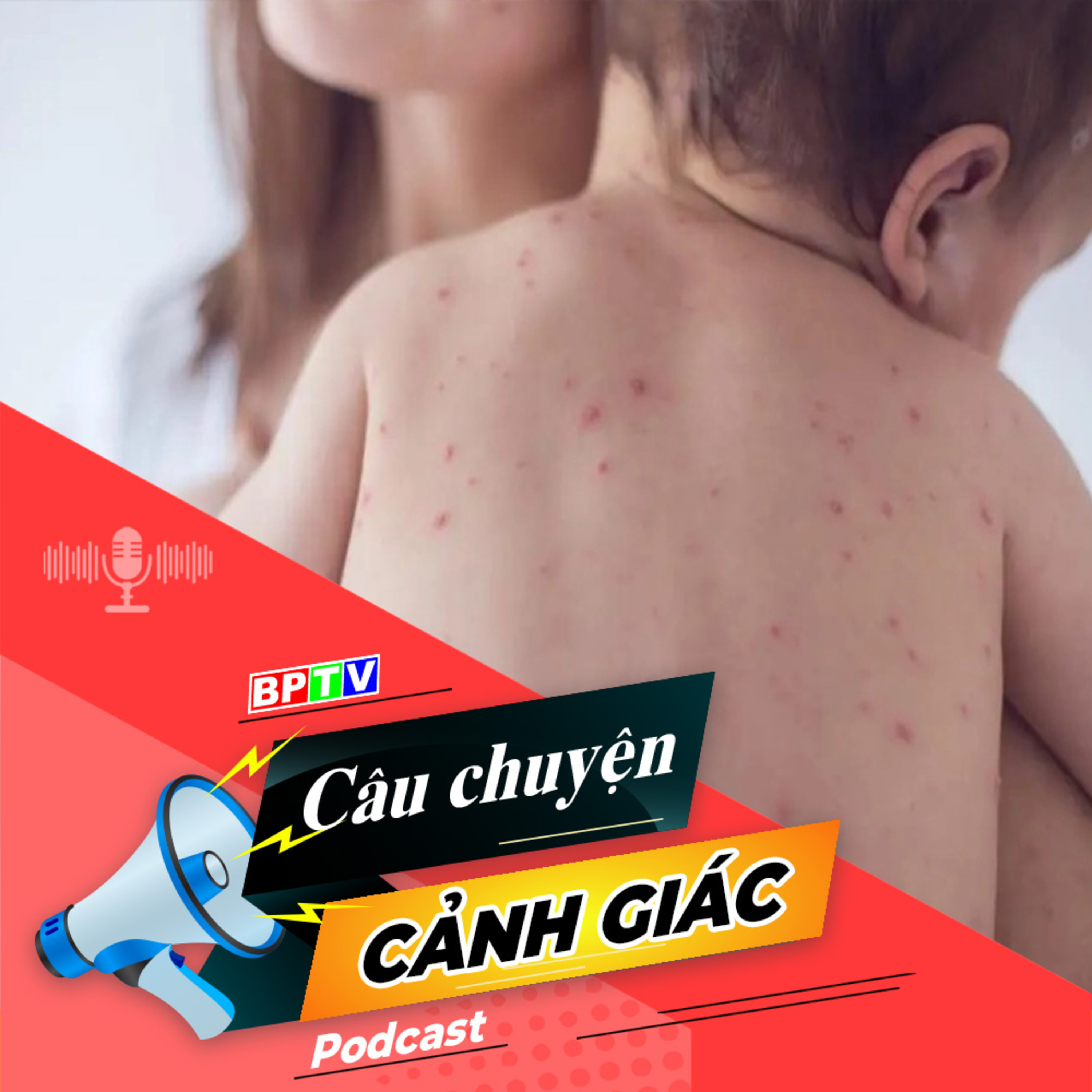 Cảnh giác với bệnh sởi ở trẻ | Câu chuyện cảnh giác episode artwork