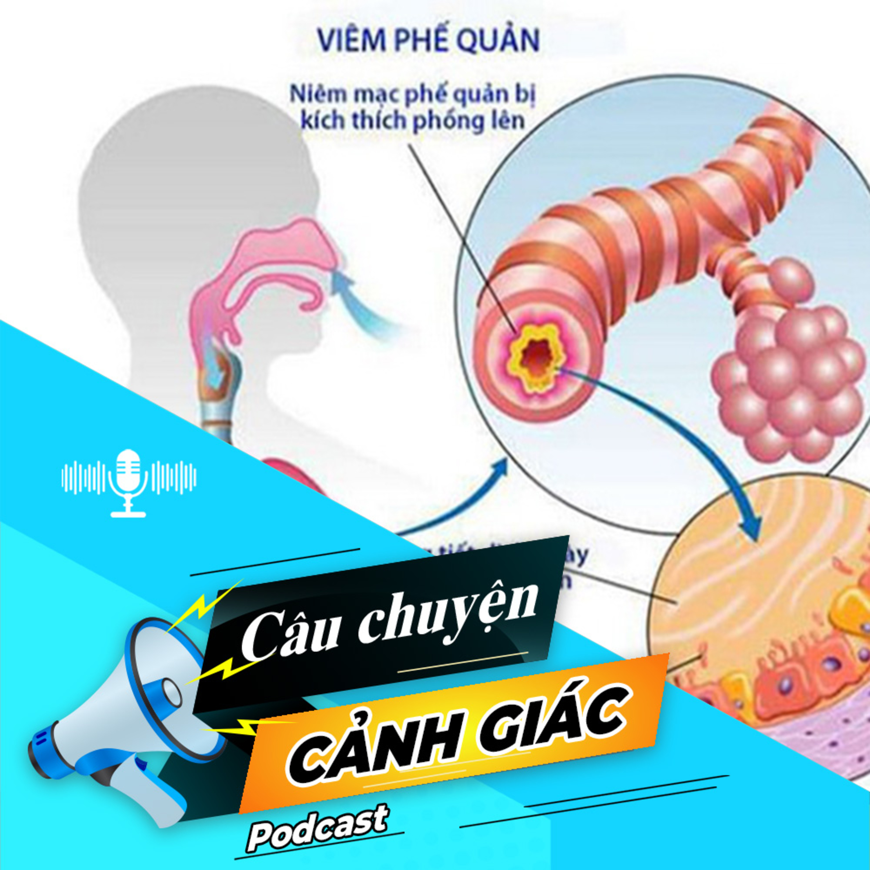 Cảnh giác với bệnh viêm phế quản | Câu chuyện cảnh giác episode artwork