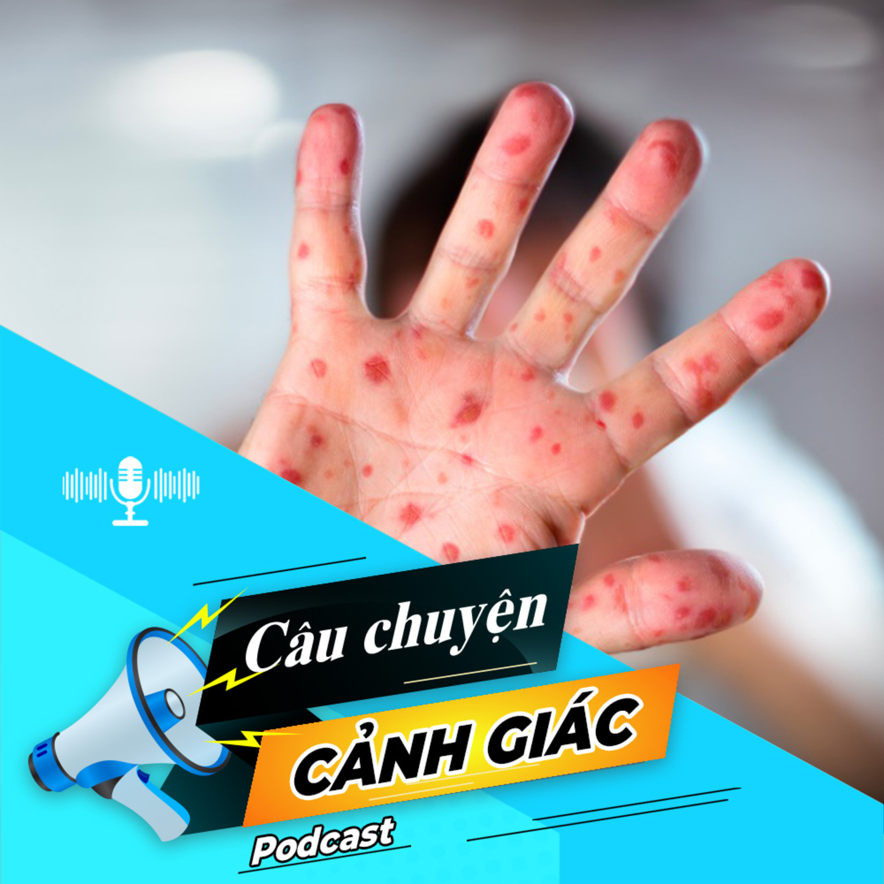 Cẩn trọng với biến chứng của bệnh sởi | Câu chuyện cảnh giác episode artwork