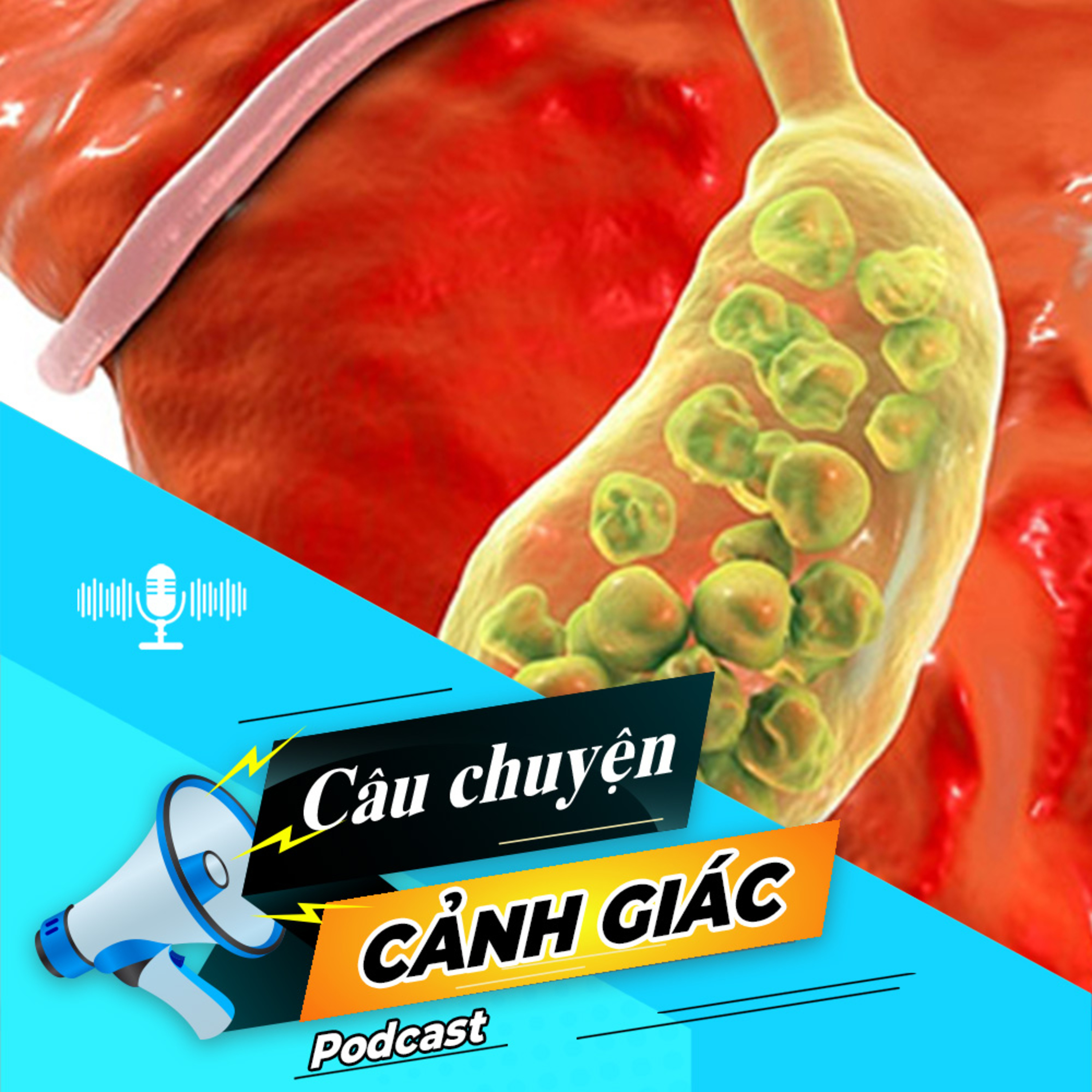 Cẩn trọng với biến chứng của sỏi túi mật | Câu chuyện cảnh giác episode artwork