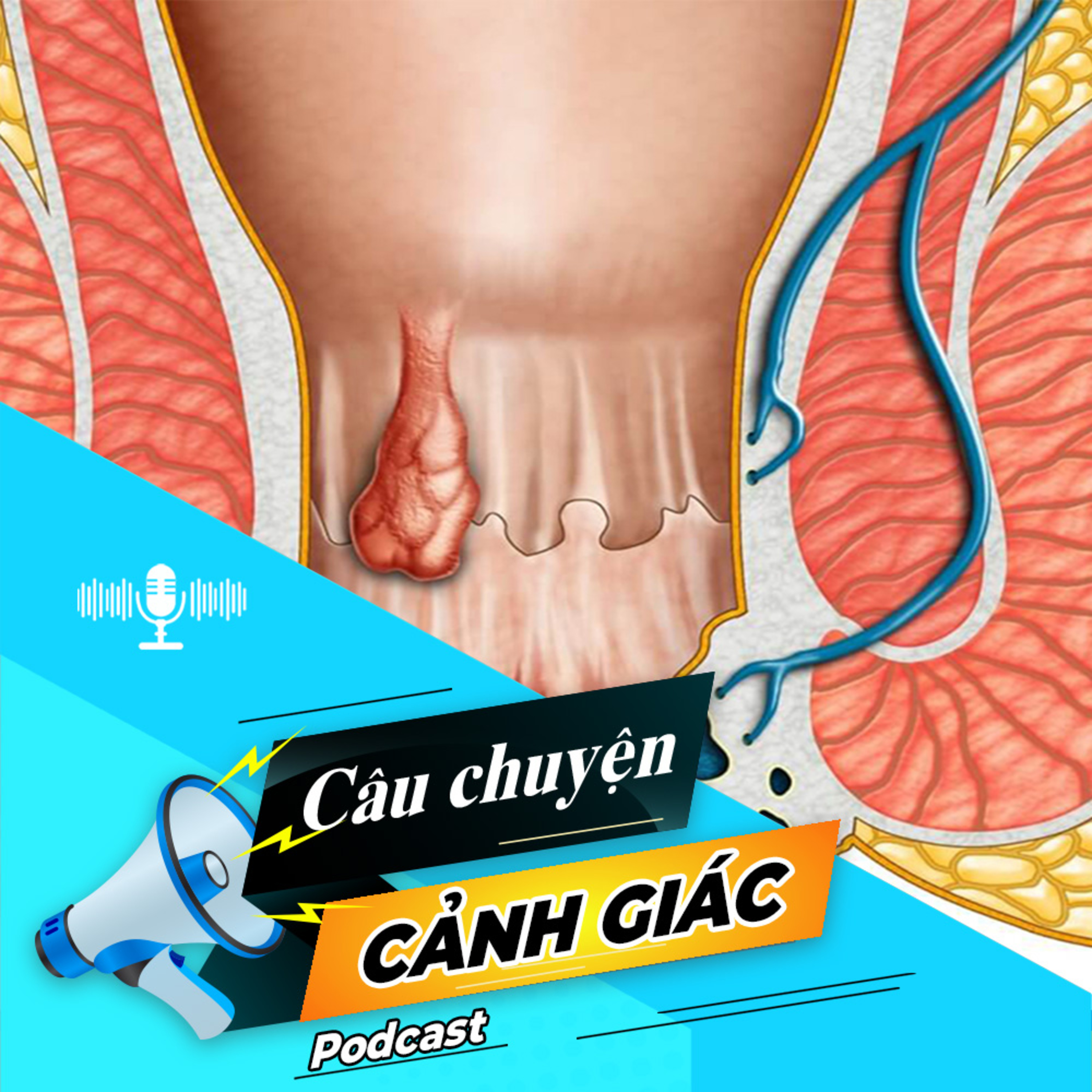 Cẩn trọng với biến chứng của trĩ nội | Câu chuyện cảnh giác episode artwork