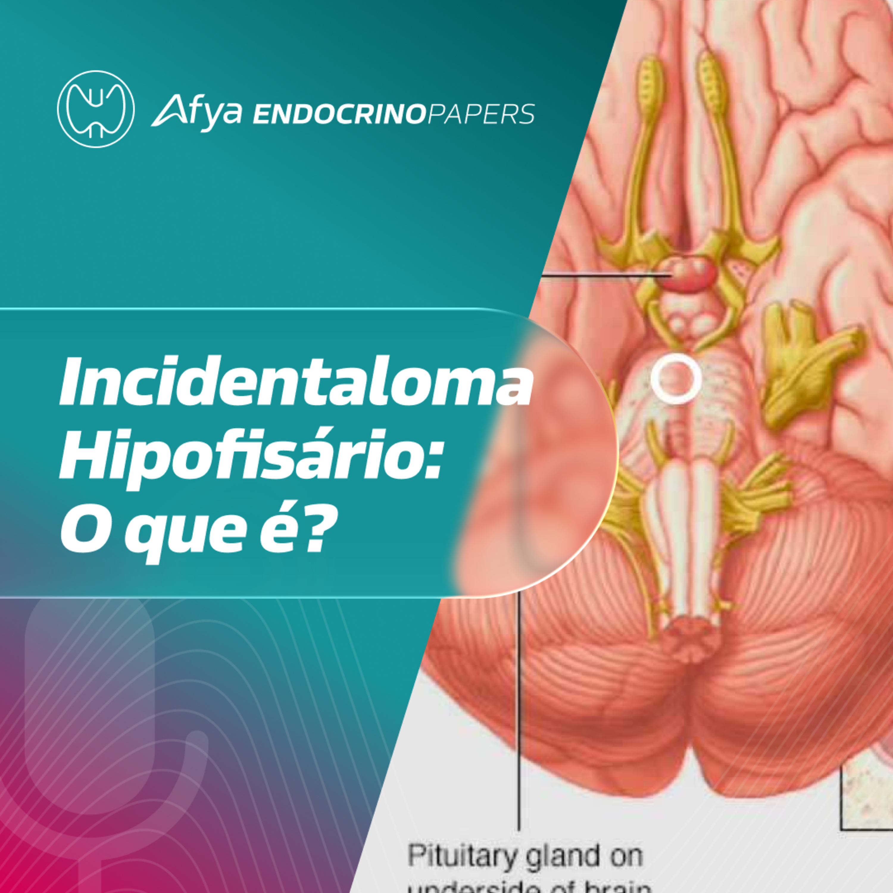 O que é um incidentaloma hipofisário e quais as etiologias mais comuns? episode artwork