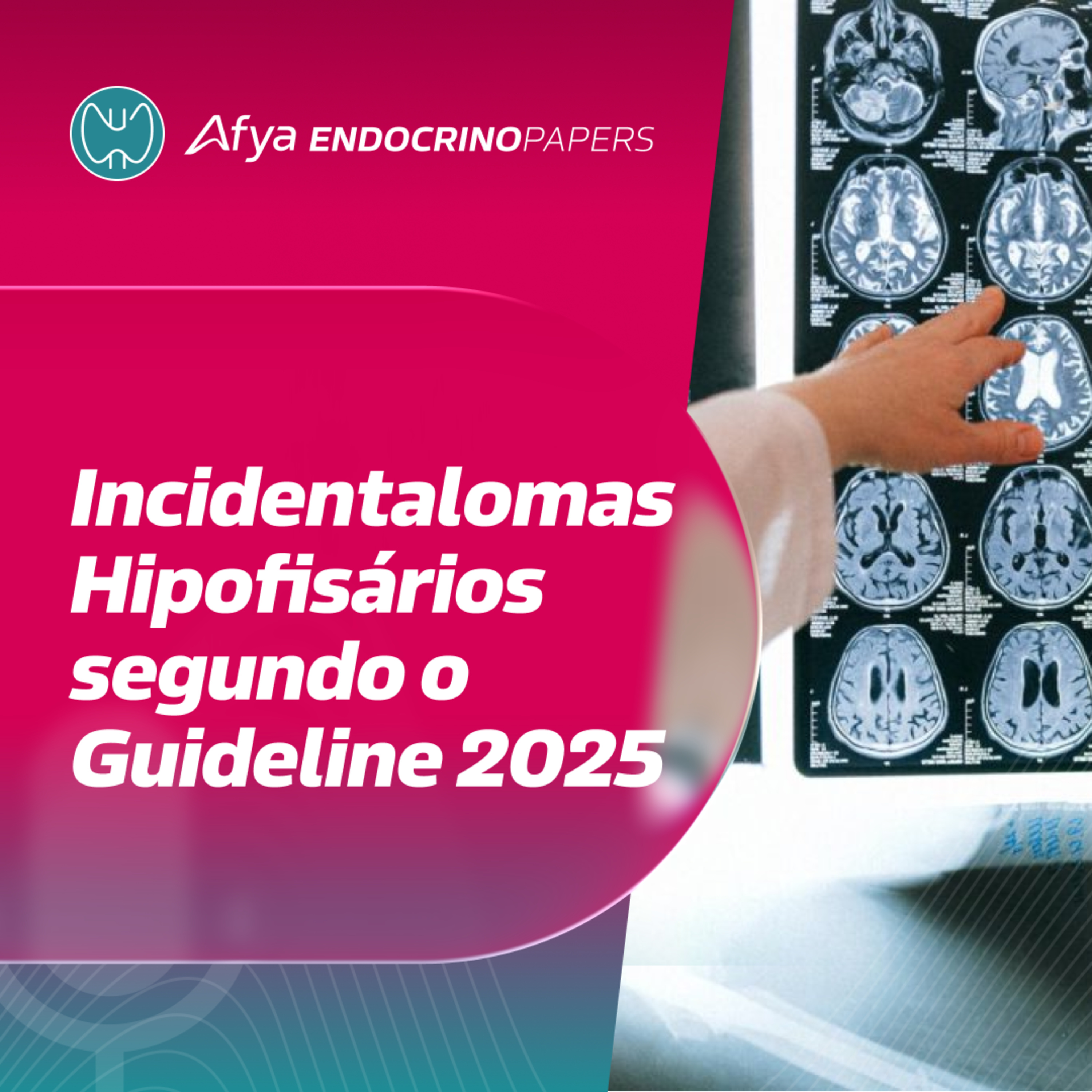 Quando repetir os testes hormonais nos casos de incidentalomas hipofisários segundo o guideline 2025? episode artwork