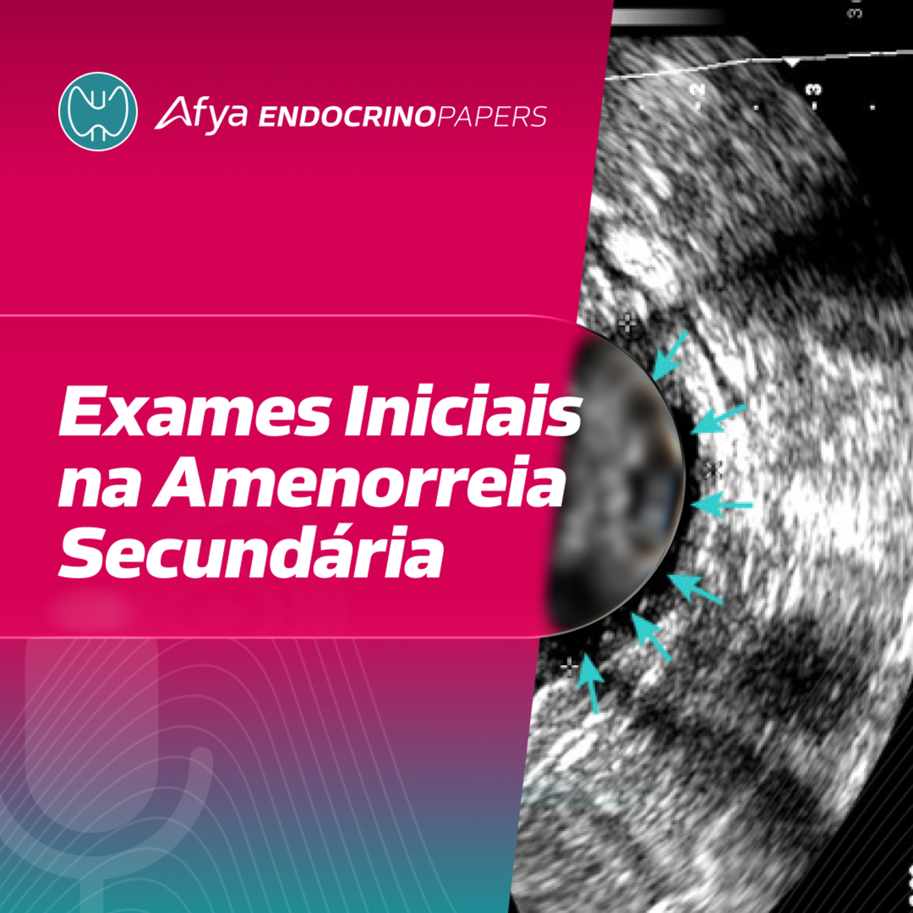 Quais exames devem ser solicitados inicialmente para uma paciente com amenorreia secundária? episode artwork