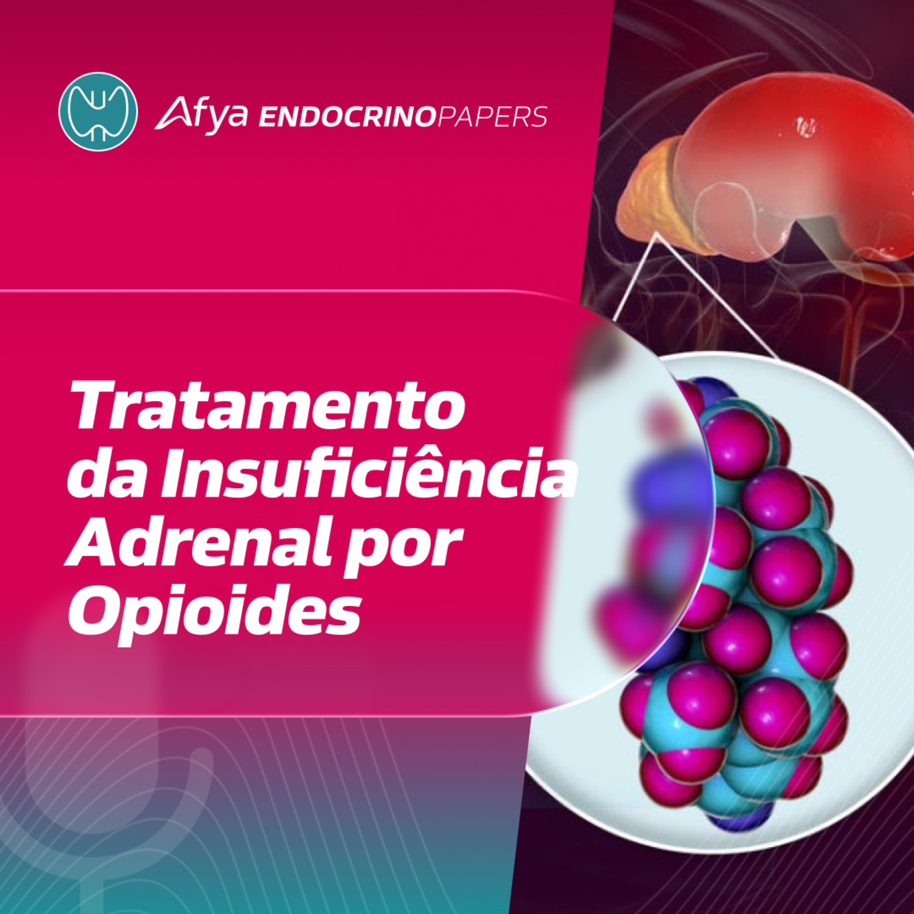 Como manejar a insuficiência adrenal associada ao uso de opioides?  episode artwork