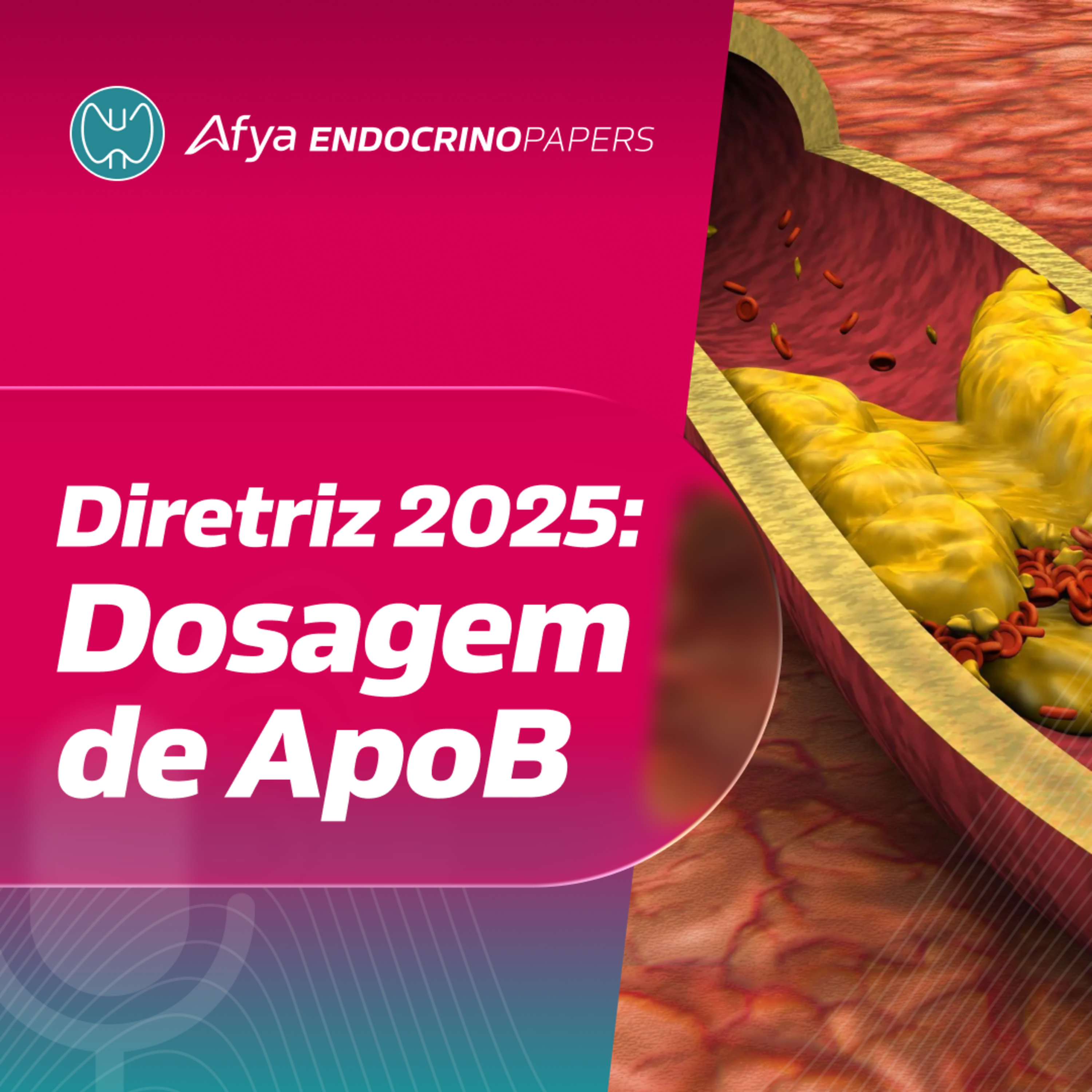 Quando solicitar dosagem de ApoB de acordo com a nova diretriz de dislipidemias? episode artwork