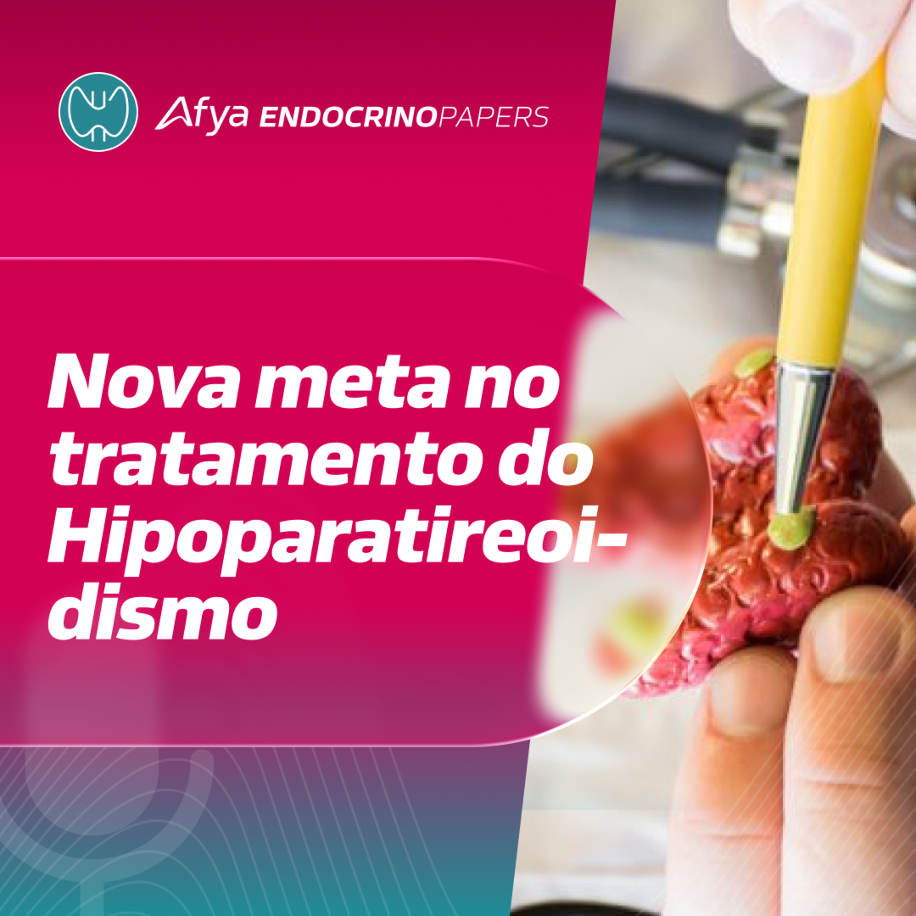 Nova meta no tratamento do hipoparatireoidismo – orientações do novo guideline europeu episode artwork