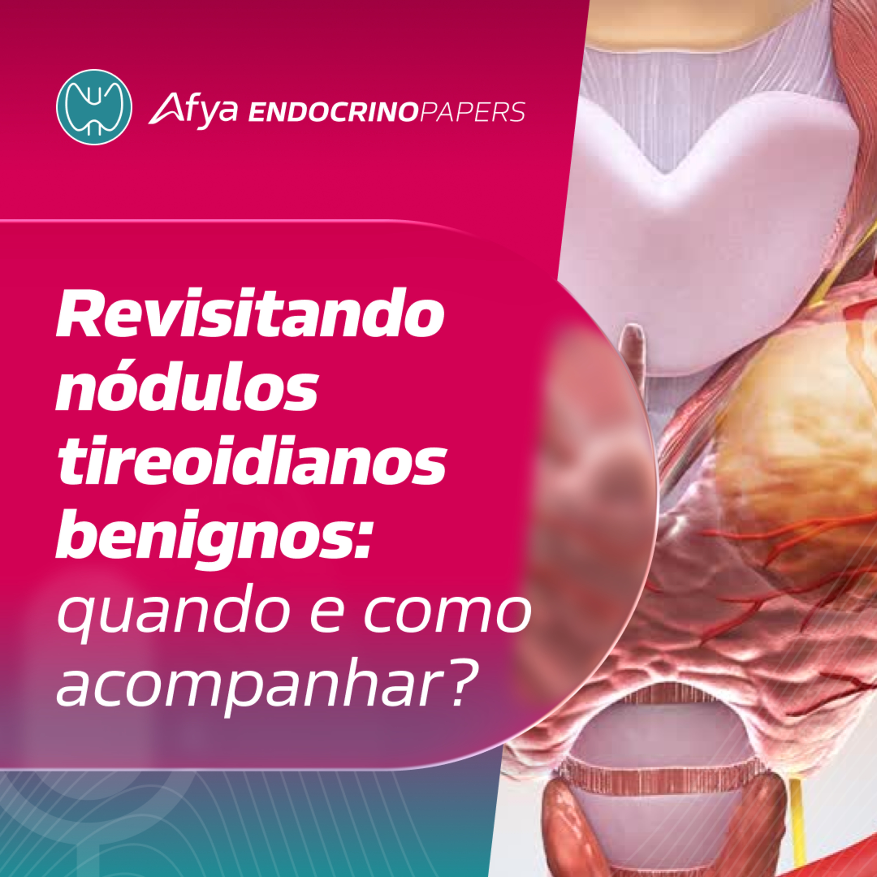 Revisitando nódulos tireoidianos benignos: quando e como acompanhar?  episode artwork