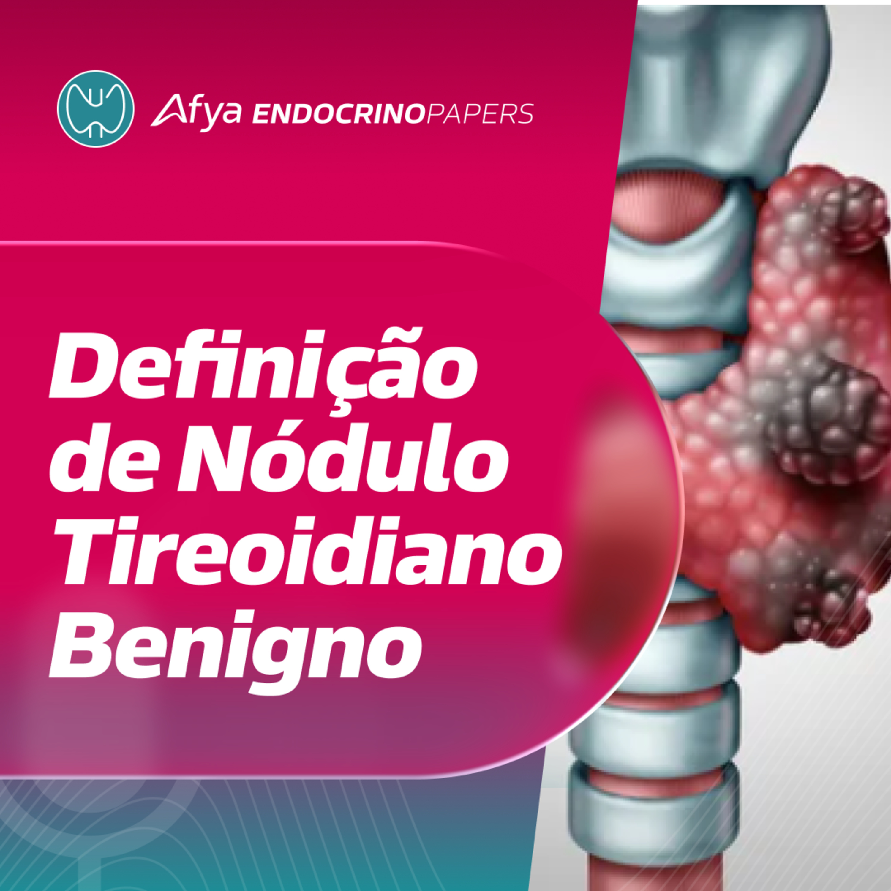 Qual é a definição de nódulo tireoidiano benigno? episode artwork