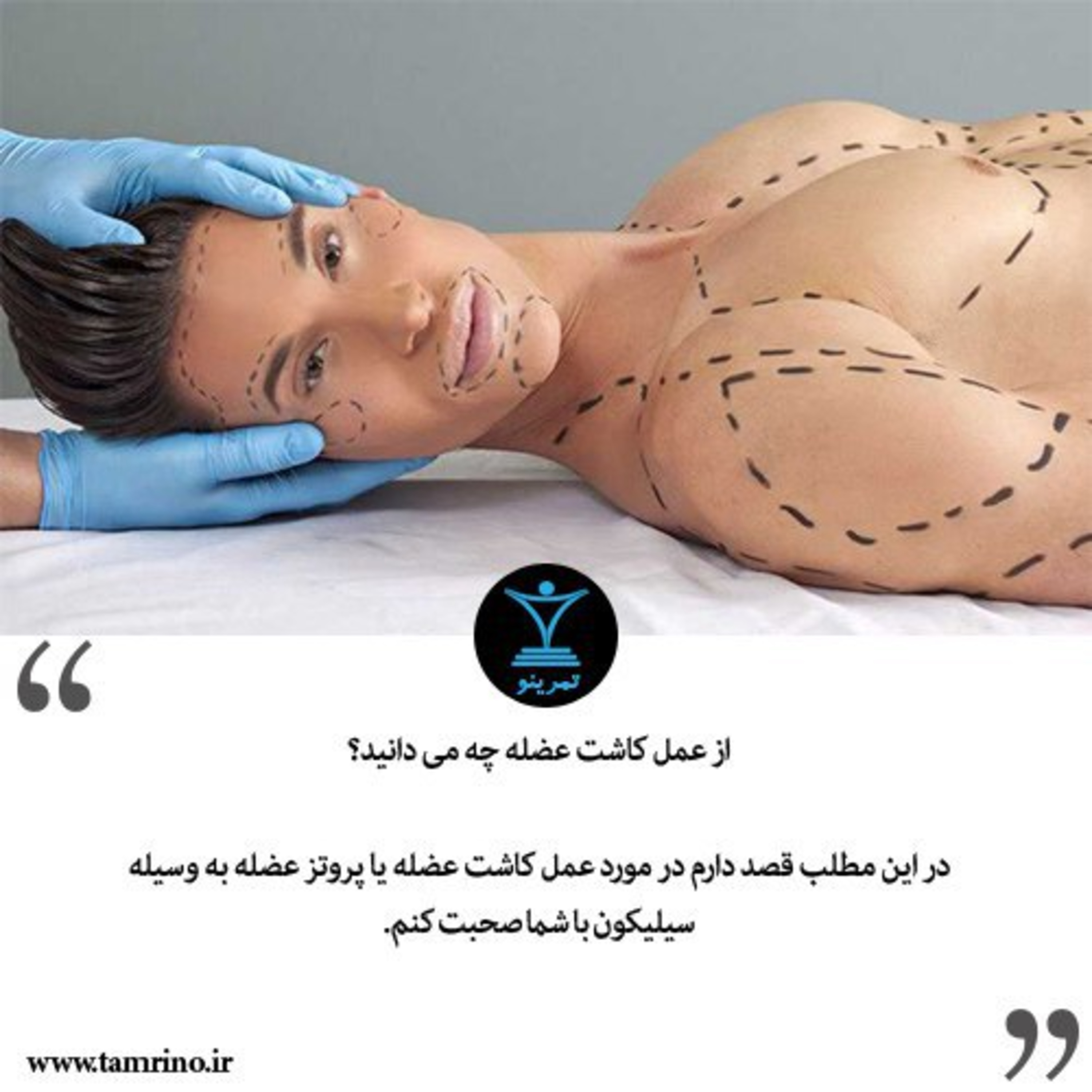 از عمل کاشت عضله چه می دانید؟ episode artwork