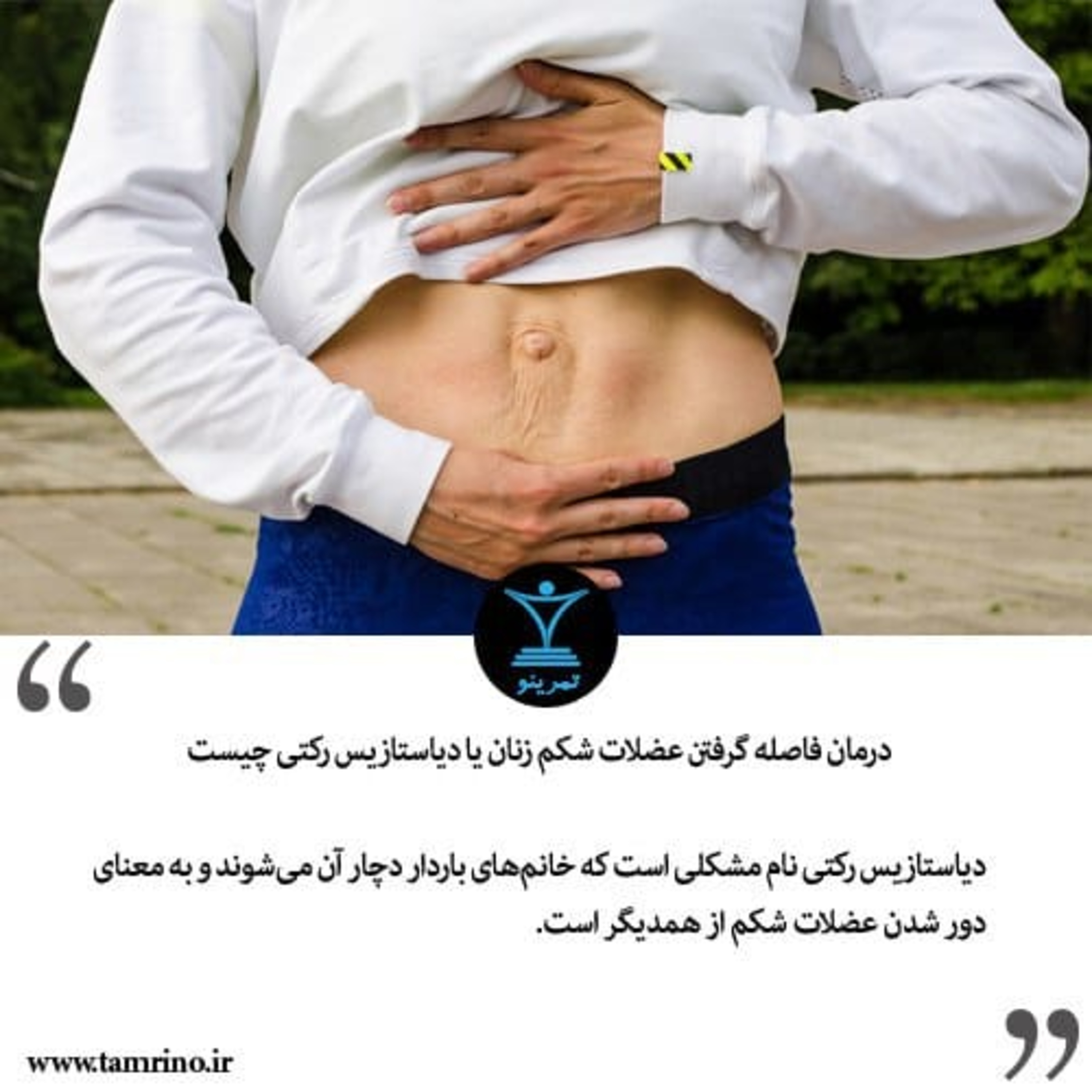 درمان فاصله گرفتن عضلات شکم زنان یا دیاستازیس رکتی چیست؟ (هوش مصنوعی) episode artwork