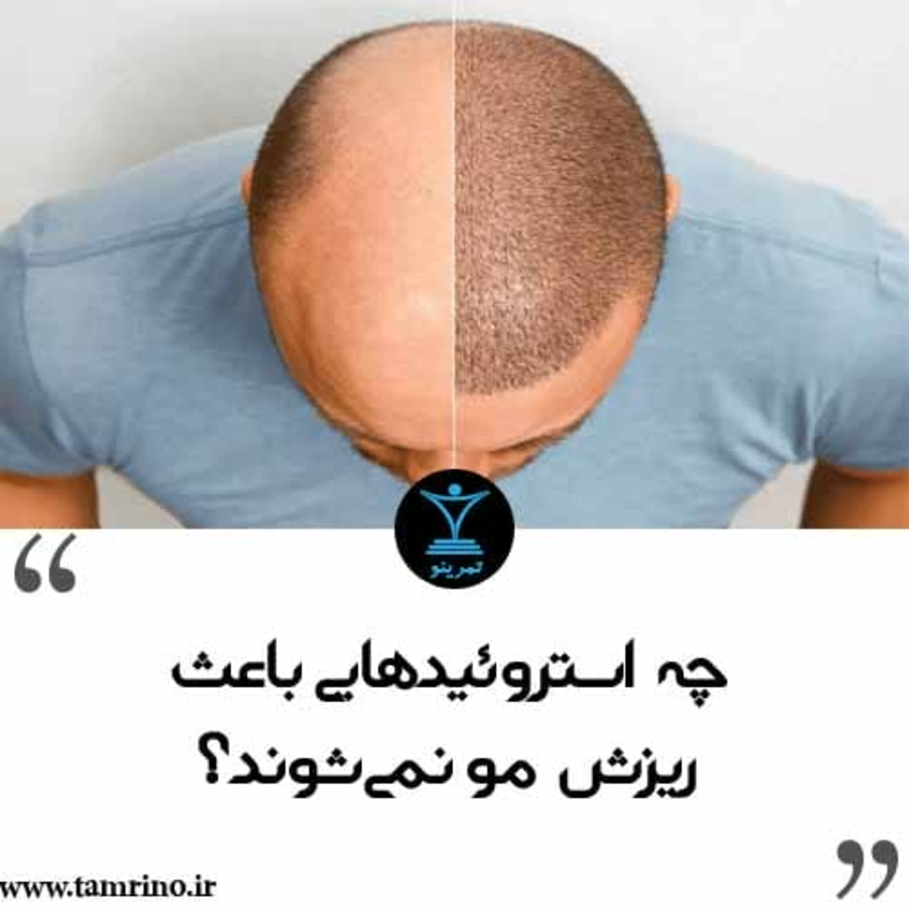 چه استروئیدهایی باعث ریزش مو نمی‌شوند؟ (نسخه هوش مصنوعی) episode artwork