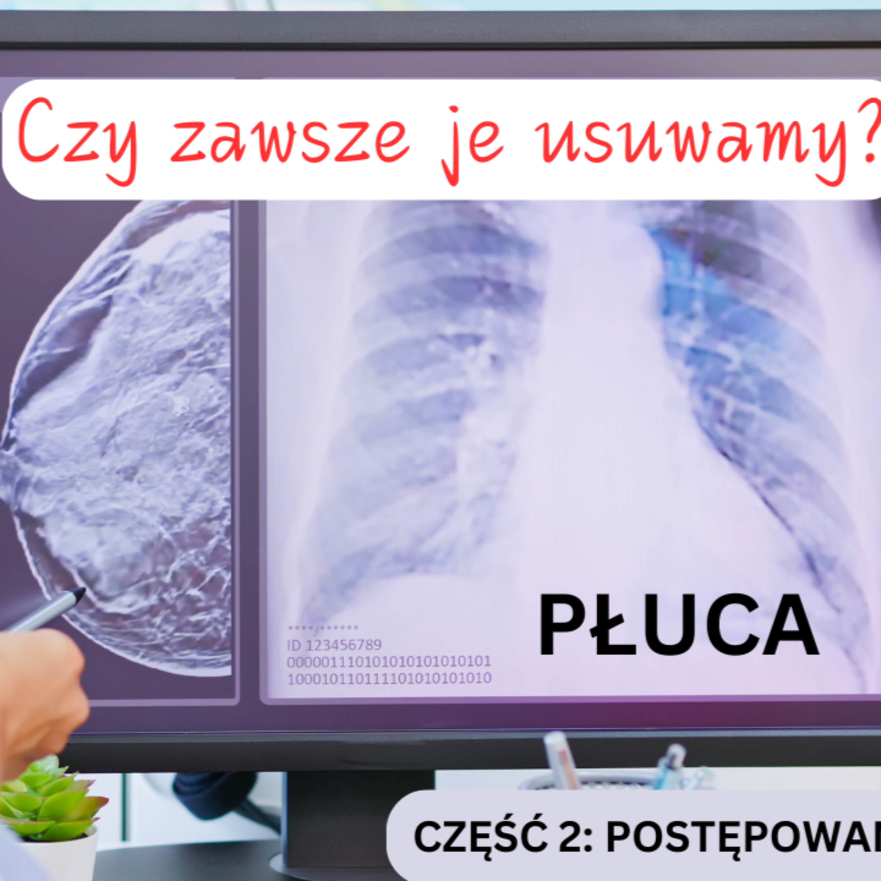 Odcinek 148. Czy zawsze usuwamy przerzuty raka piersi do płuc? episode artwork
