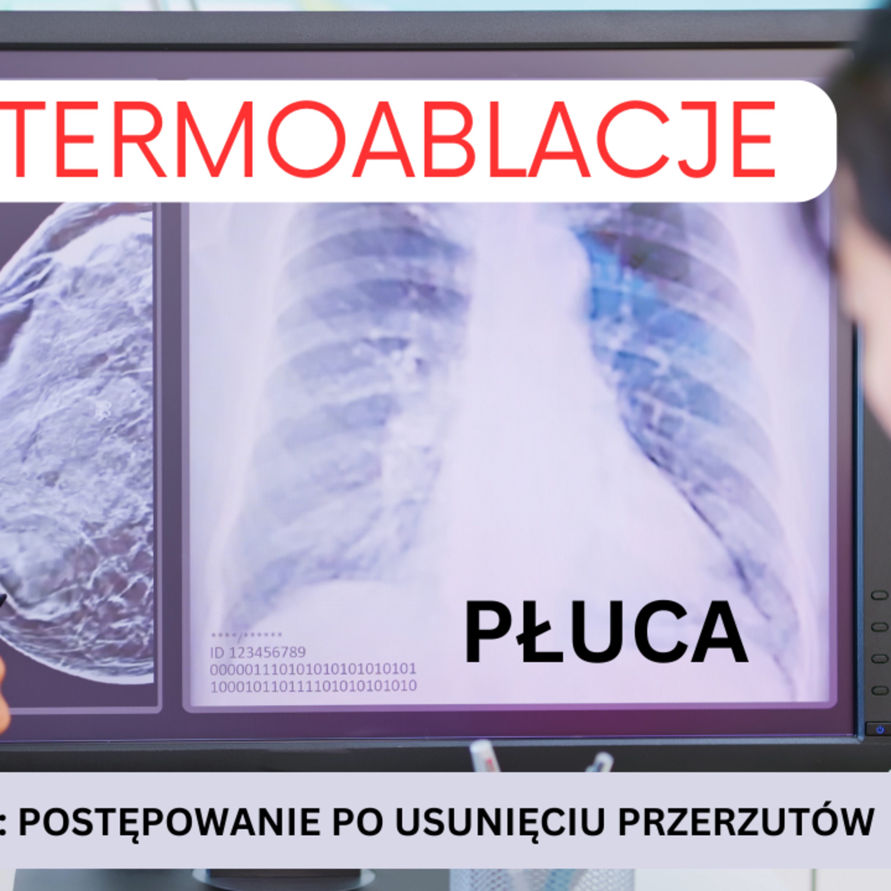 Odcinek 151. Termoablacje jako metoda usuwania przerzutów do płuc. Kiedy i u kogo ma sens. episode artwork