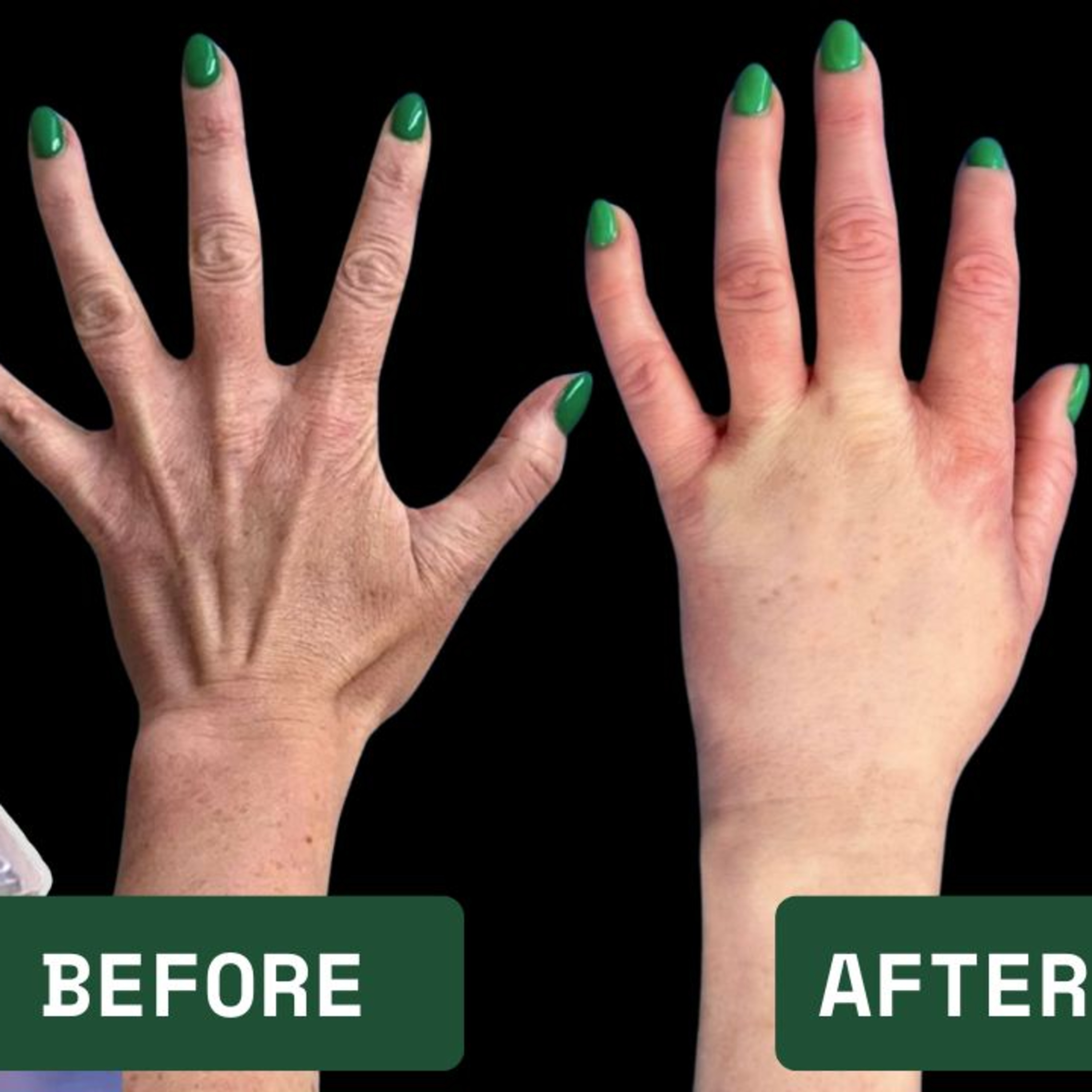 Fat Transfer to Hands (Podcast) - How It's Done episode artwork