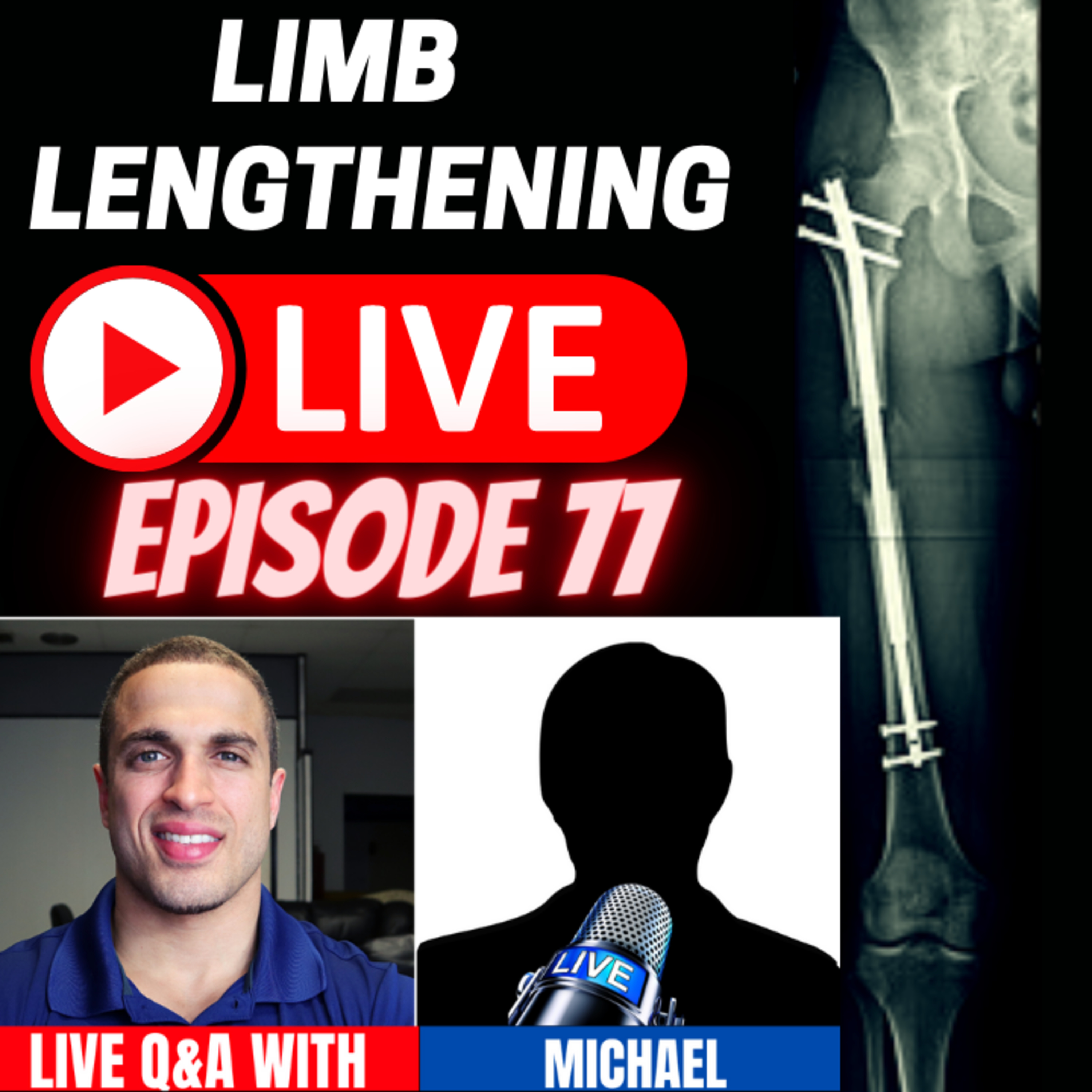 Limb Lengthening LIVE Episode 77 - LIVE with CLL patient Michael