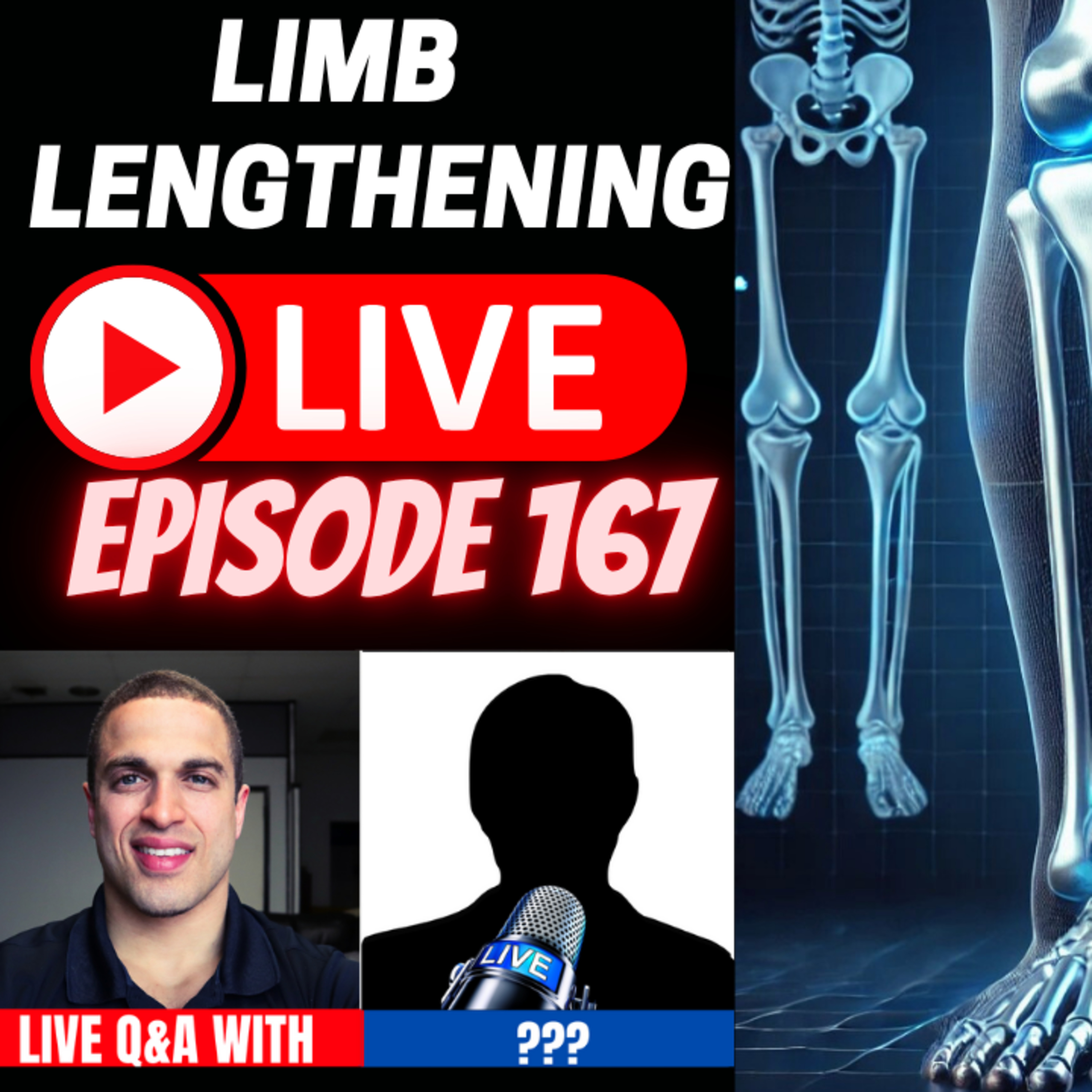 Limb Lengthening LIVE Episode 167 - Deciding which Limb Segment to Lengthen