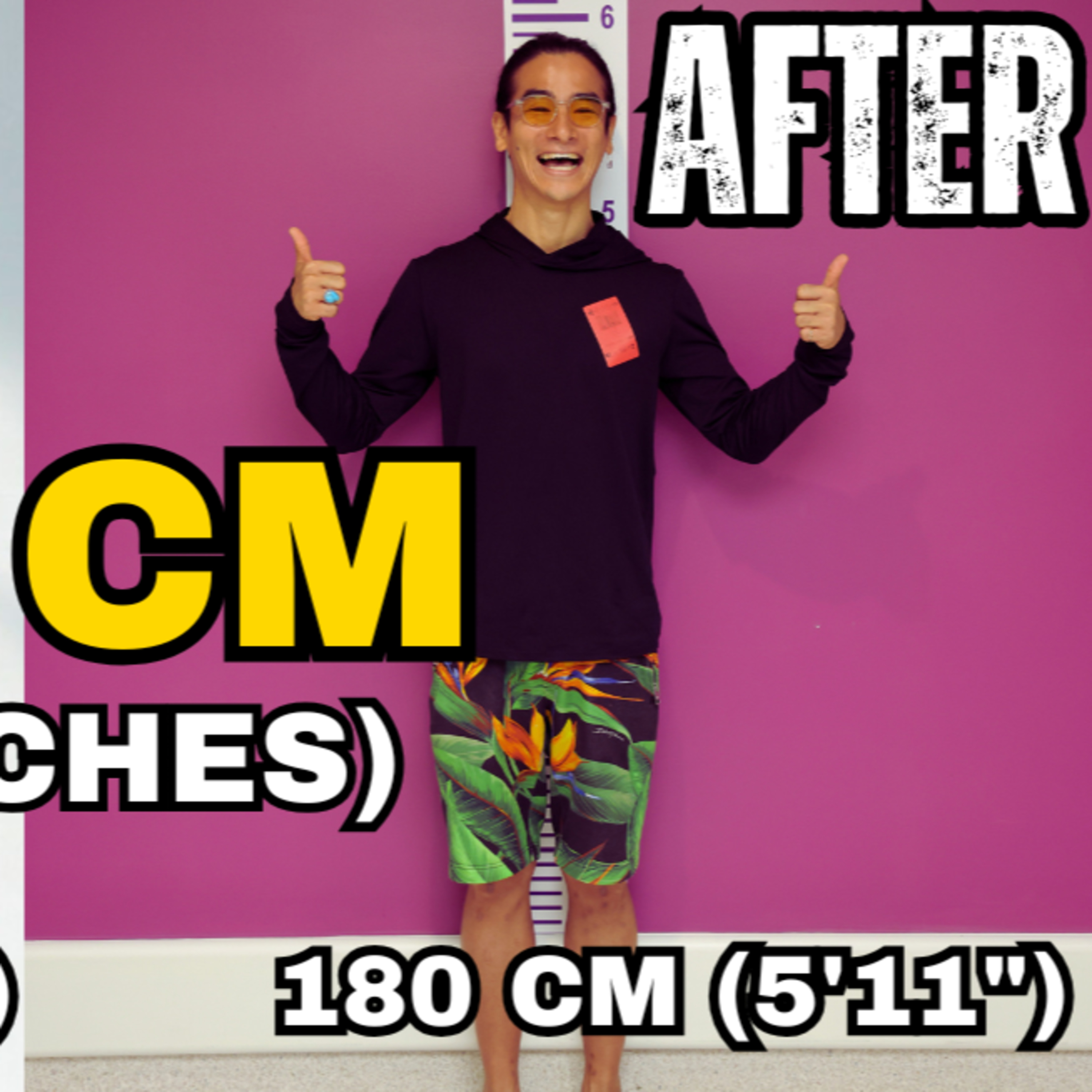 Limb Lengthening Podcast