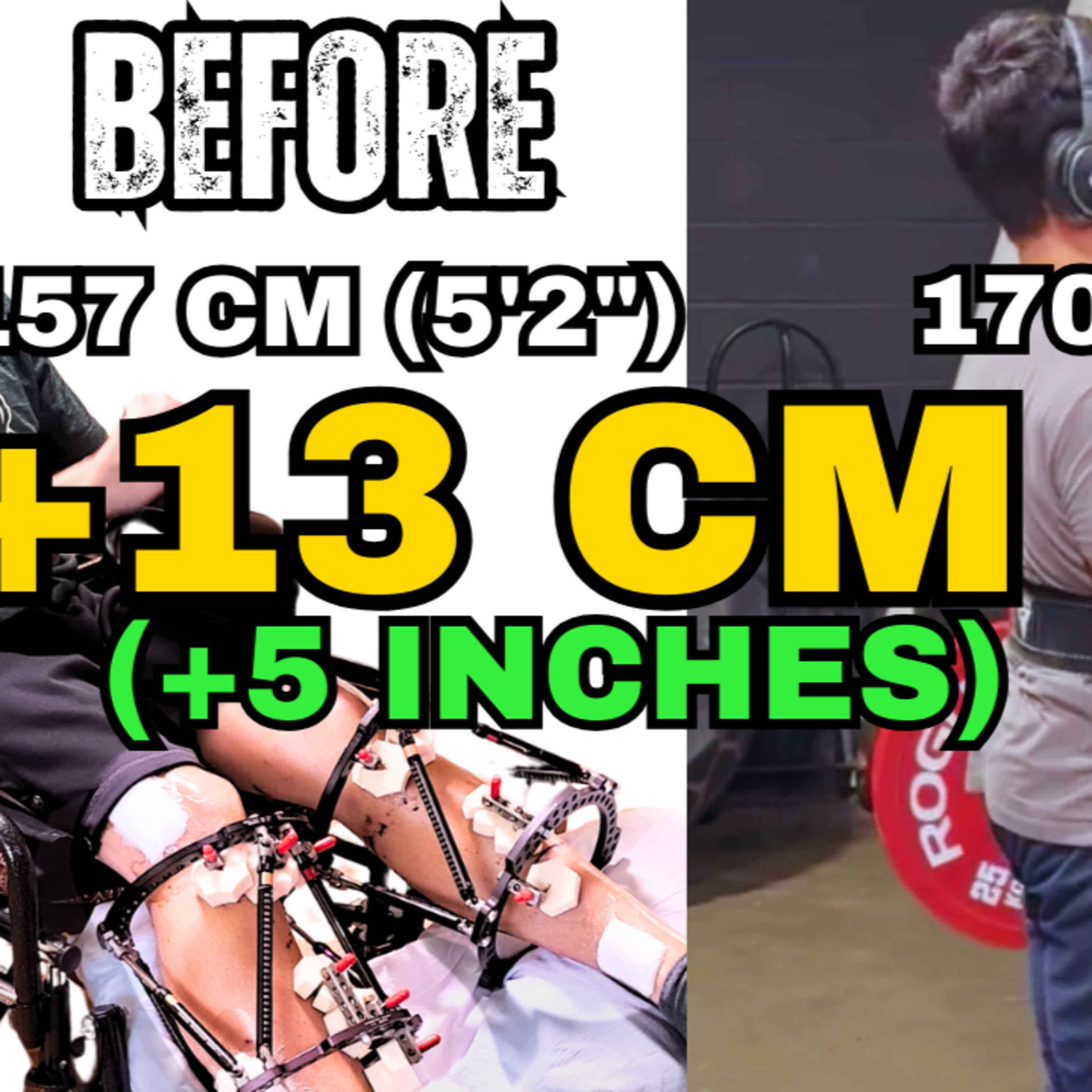 Limb Lengthening Podcast